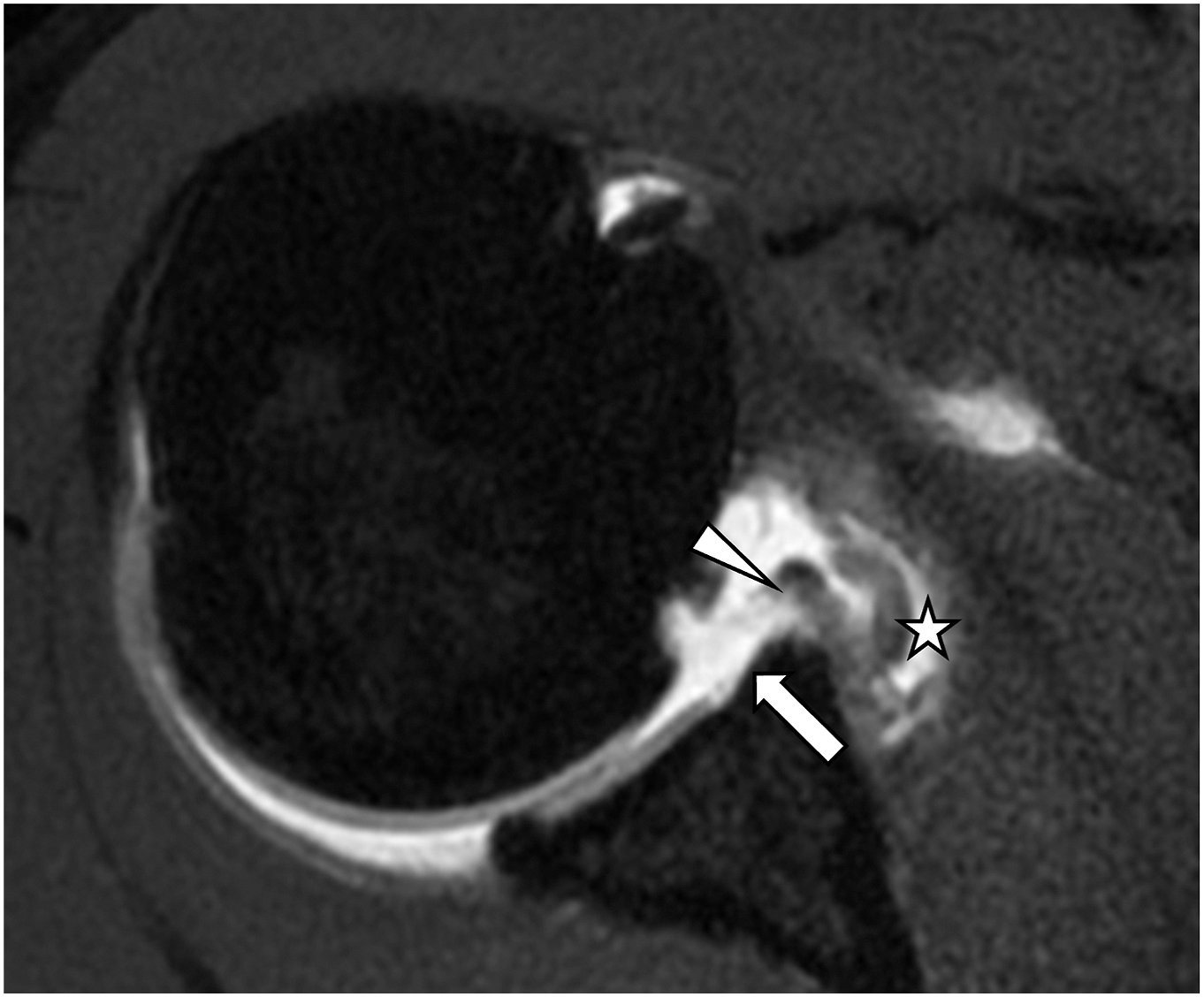 An M R I arthrogram of a shoulder joint shows a tear in the anterior labrum, indicated by an arrowhead, and a large cartilage defect, indicated by an arrow.