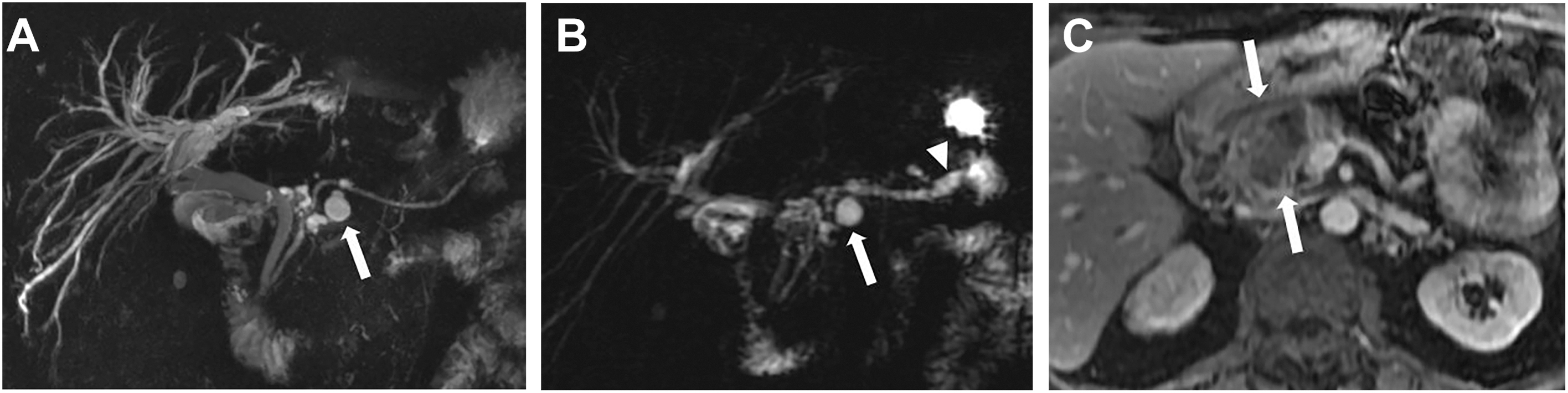 A three-panel M R I and M R C P study of a 76-year-old female shows the progression from stable cystic lesions to a 3.6-centimeter hypoenhancing pancreatic head mass and ductal dilation.