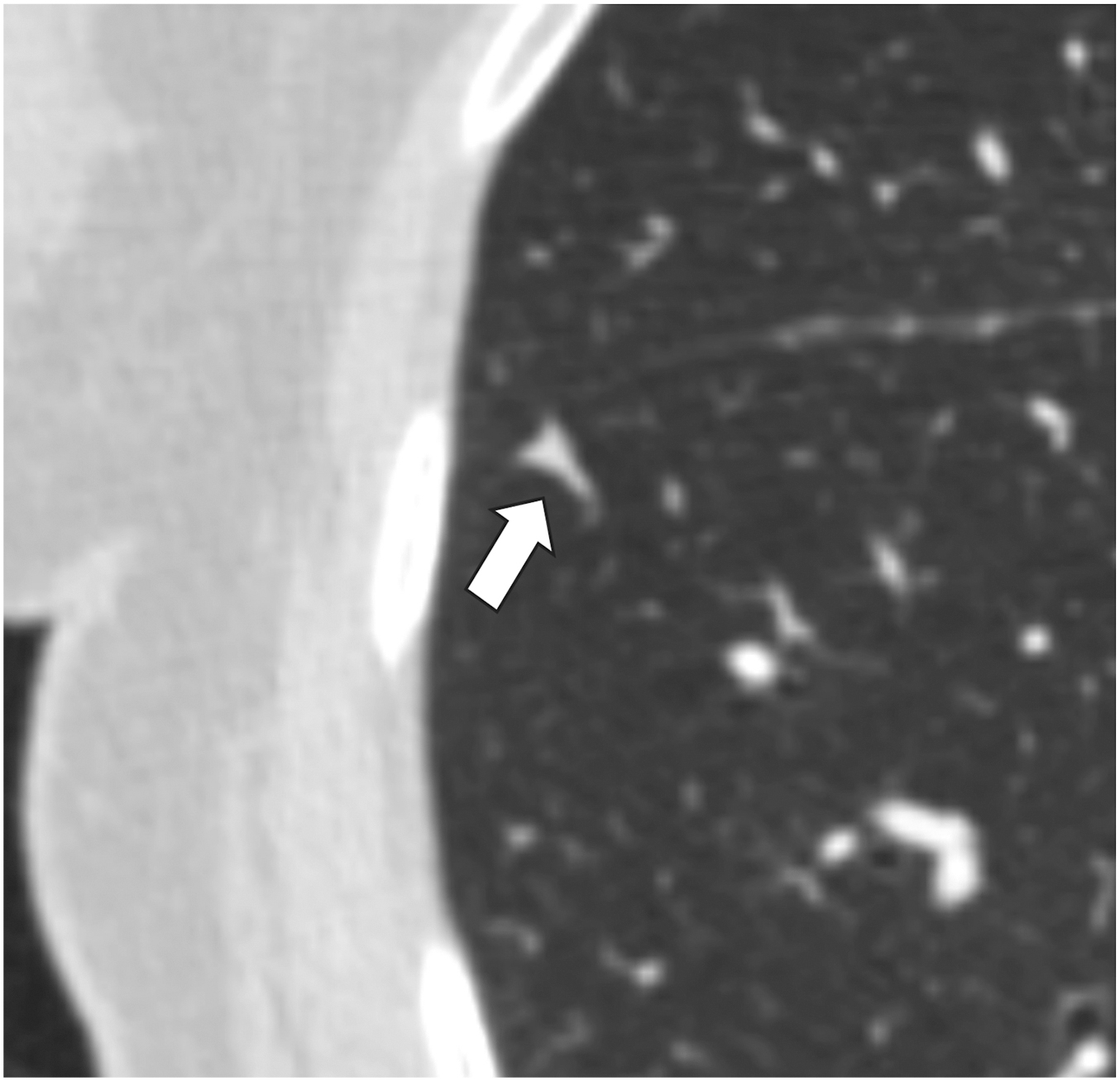 A lung-R A D S category 2 axial unenhanced chest CT scan in lung window shows a small, benign 3 millimeter solid perifissural triangular nodule in the right lower lobe, indicated by an arrow.