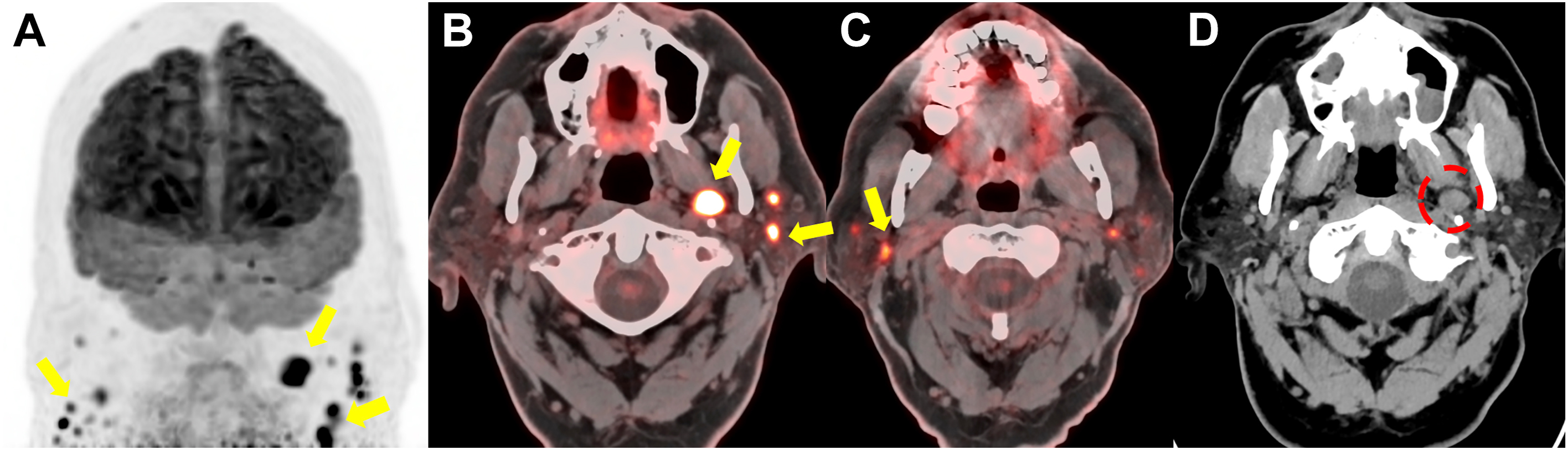 Four head and neck scans labeled A to D featuring positron emission tomography overlays and markers at symmetrical locations.