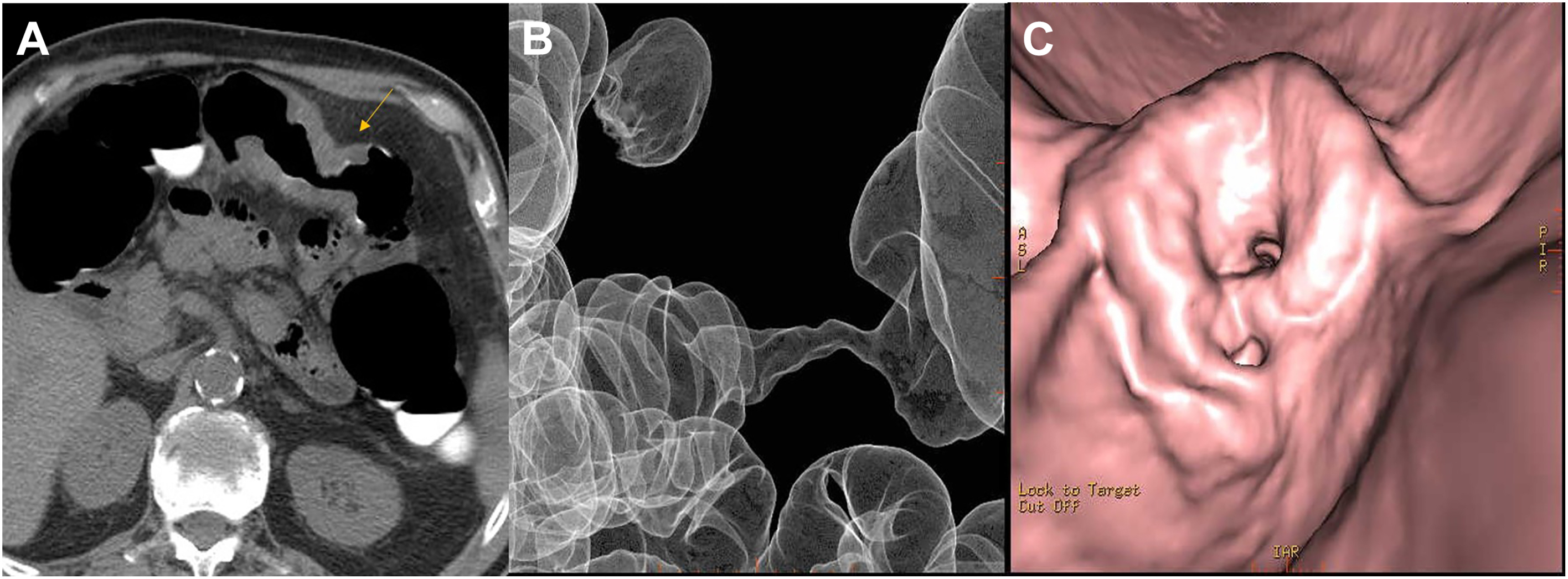 Three panels show an annular constricting adenocarcinoma mass in the transverse colon of a 74-year-old male, identified via 3 D endoluminal, 2 D axial, and 3 D surface-rendered C T colonography.