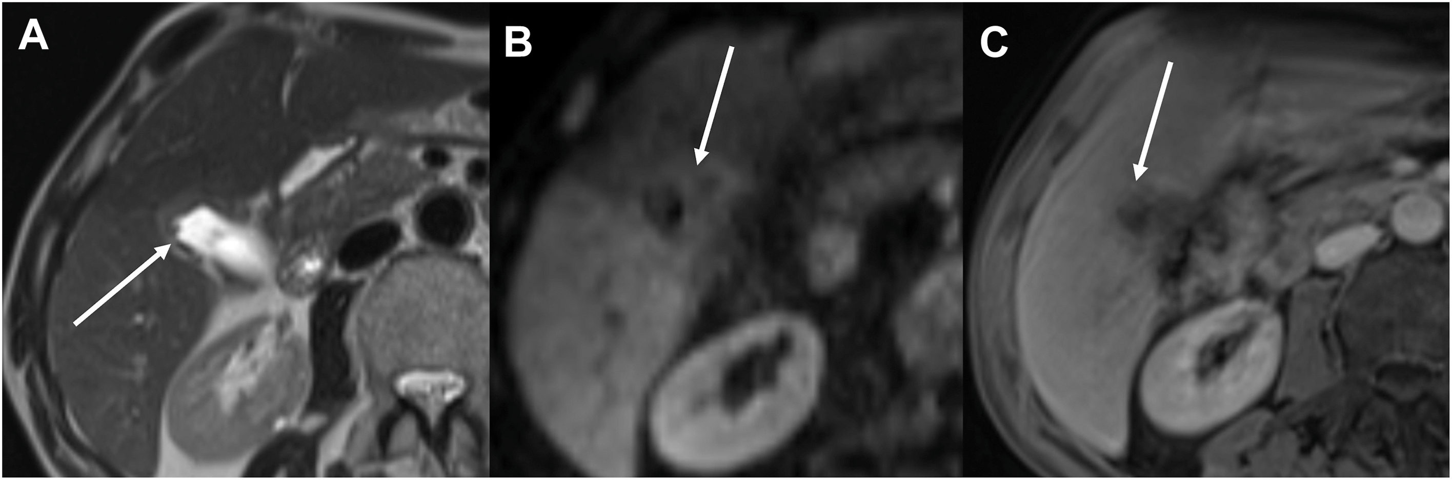 A three-panel axial magnetic resonance imaging shows focal malignant gallbladder wall thickening with indistinct liver interface, diffusion restriction, and heterogeneous post-contrast enhancement.
