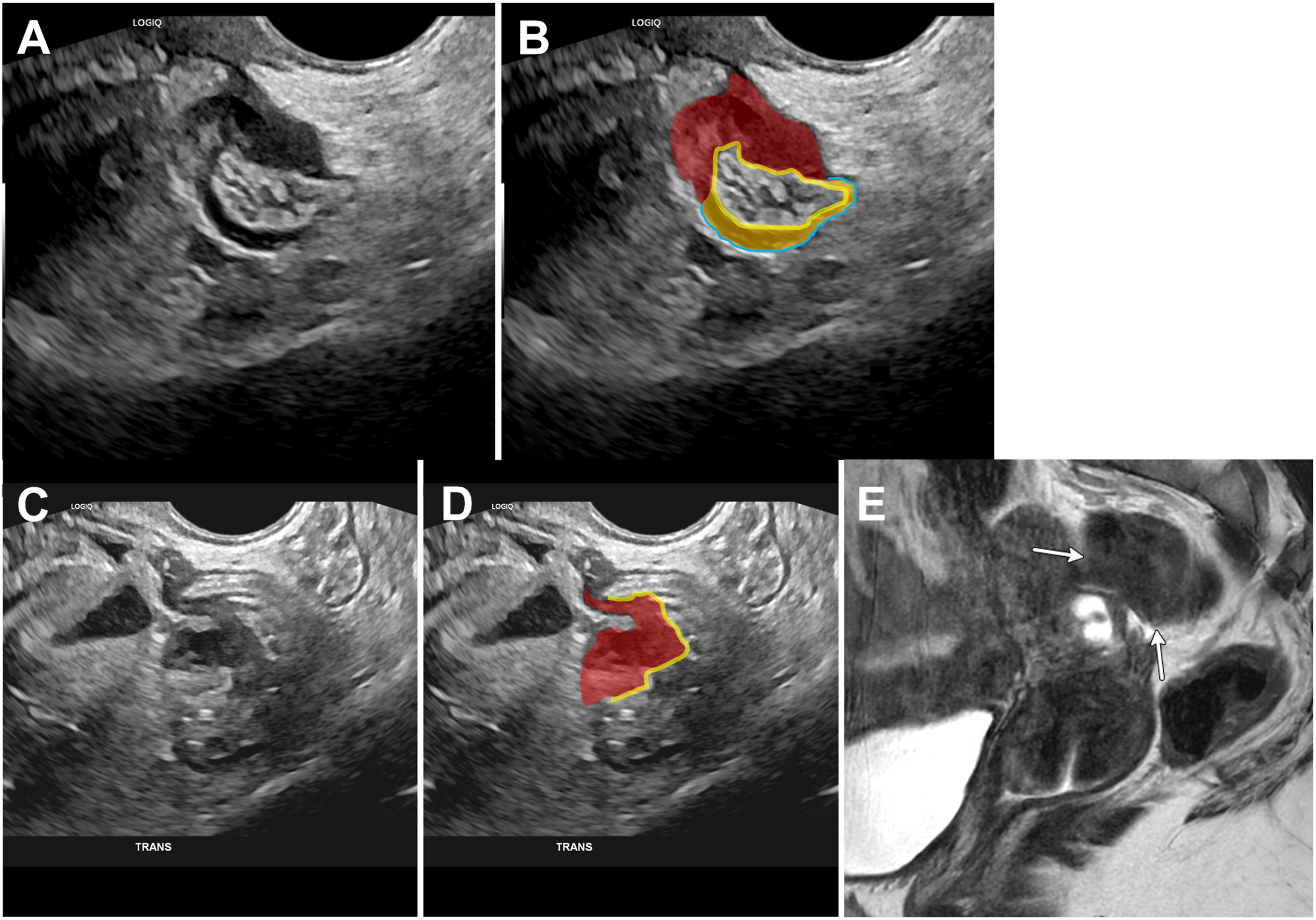 Five panels show rectosigmoid deep endometriosis with an omega-shaped hypoechoic lesion invading the anterior rectal wall on transvaginal ultrasound and a T 2-dark plaque with mushroom cap sign.