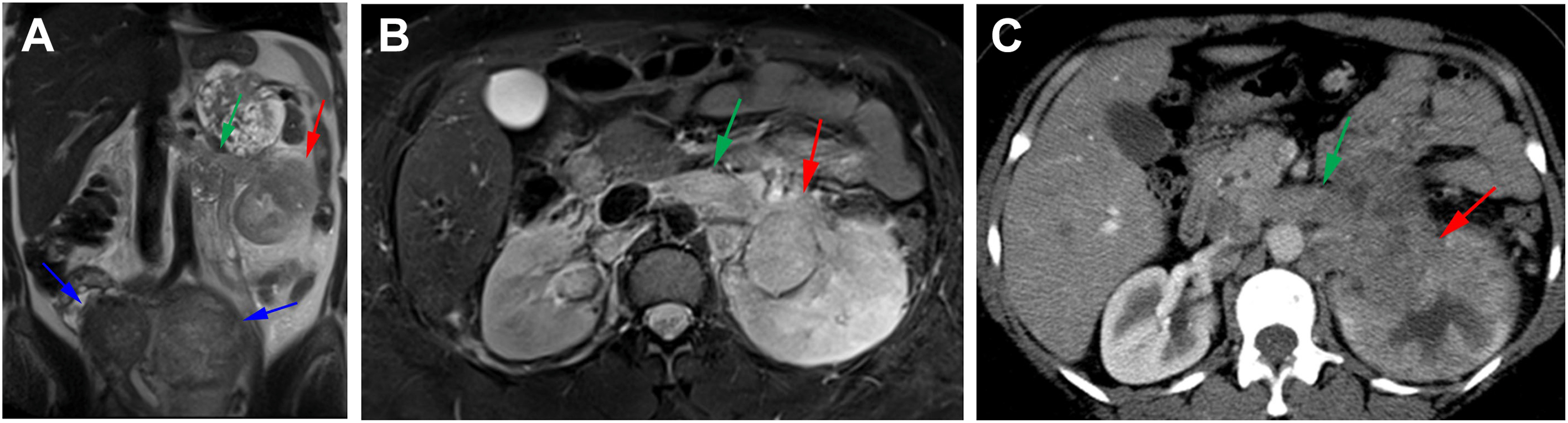 Three panels with M R I and C T shows a left renal carcinoma with renal vein tumor thrombus and uterine leiomyomas in a woman with H L R C C syndrome.