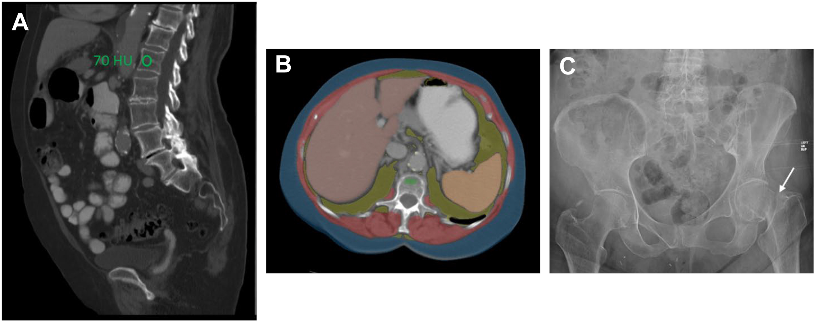 Three panels of an elderly woman show low lumbar bone attenuation on C T, automated body composition overlays, and a later pelvic radiograph with a left proximal femur fracture.