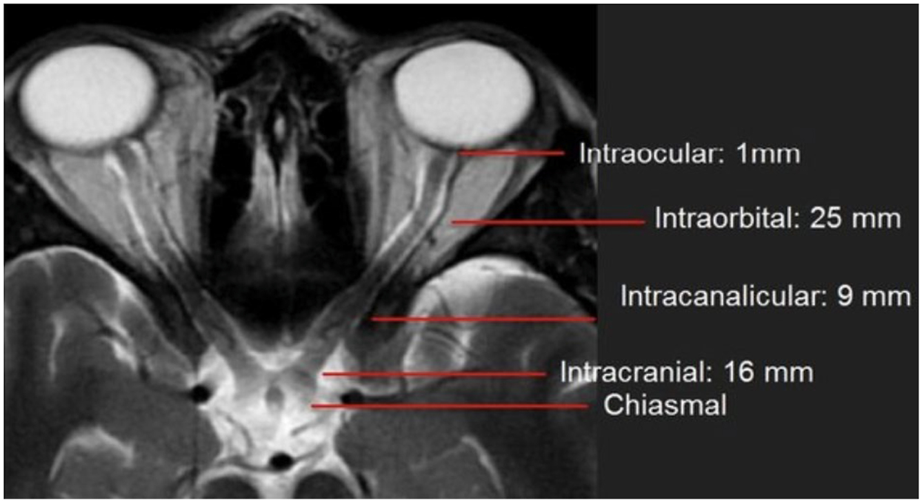 A magnetic resonance scan in axial T 2-weighted sequence demonstrating five labeled segments of the optic nerve with their respective lengths.