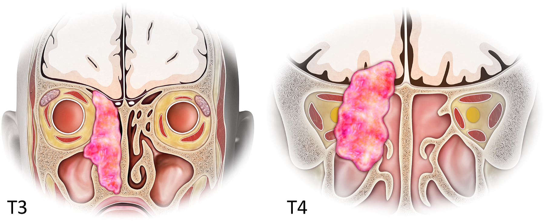A labeled anatomical diagram shows T 3 and T4 stage tumors of the ethmoid sinus and nasal cavity with orbital and cranial involvement.