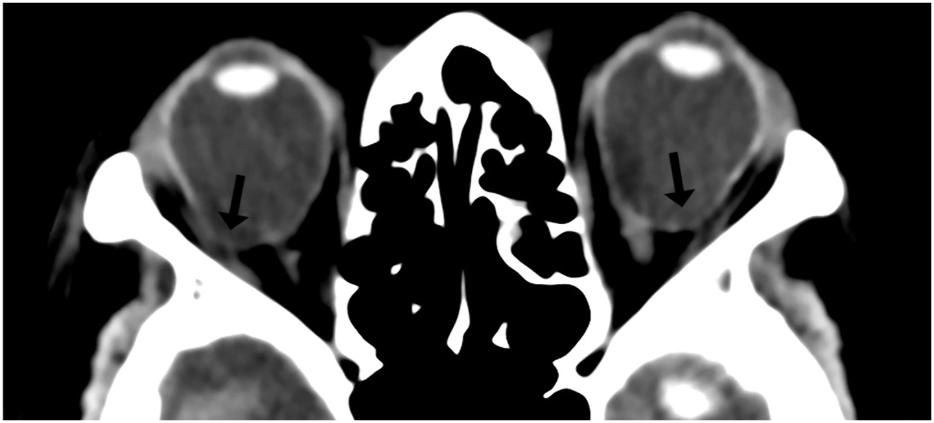 A C T scan of orbits shows bilateral posterior staphylomas with elongated globes and focal posterior ectasia, without evidence of scleral defect (arrows).