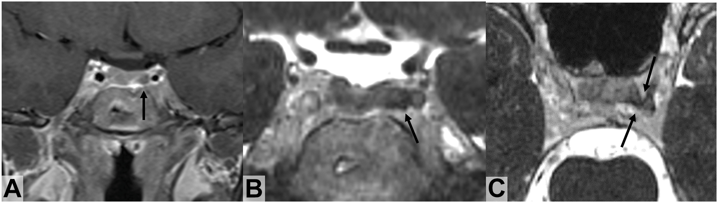 A three-panel coronal T 1-weighted and C I S S M R I scans show a pituitary adenoma where T 1 imaging shows no invasion, but C I S S reveals a tiny nubbin protruding into the cavernous sinus.
