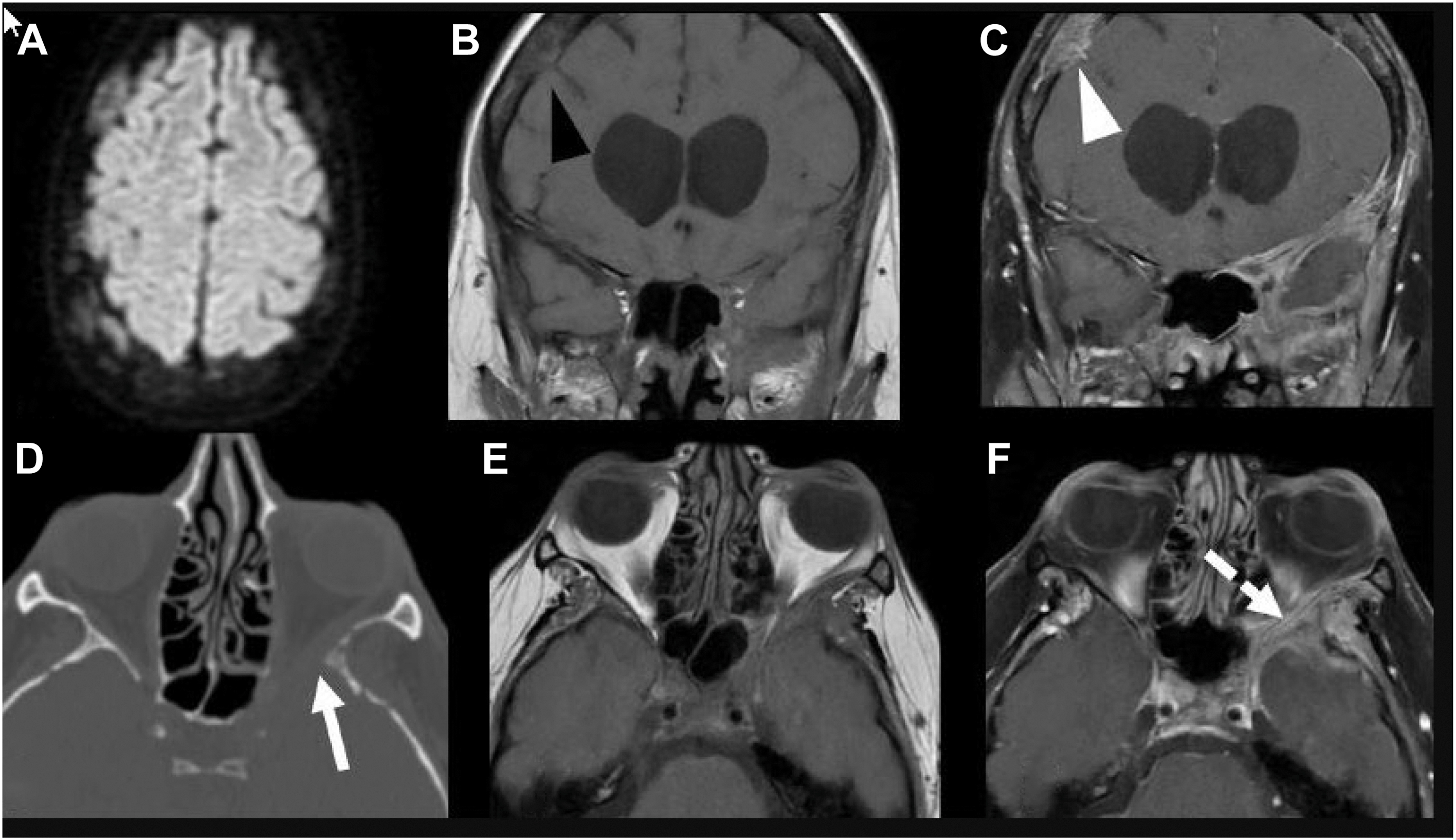 A six-panel imaging scan of skull breast cancer metastases shows lytic lesions, restricted diffusion, dural extension, and involvement of the sphenoid wings and orbital apex.