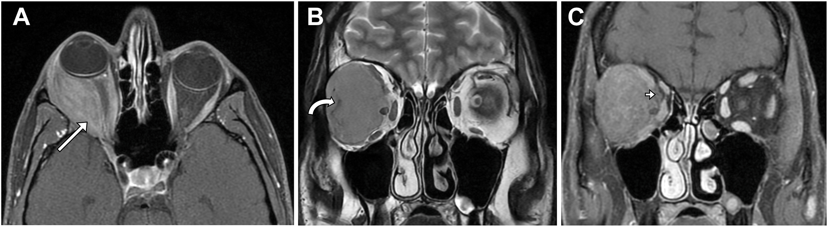 A three-panel magnetic resonance scan depicts a right orbital acute myeloid leukemia relapse, showing an intraconal mass distorting the optic nerve and engulfing the lateral rectus muscle.