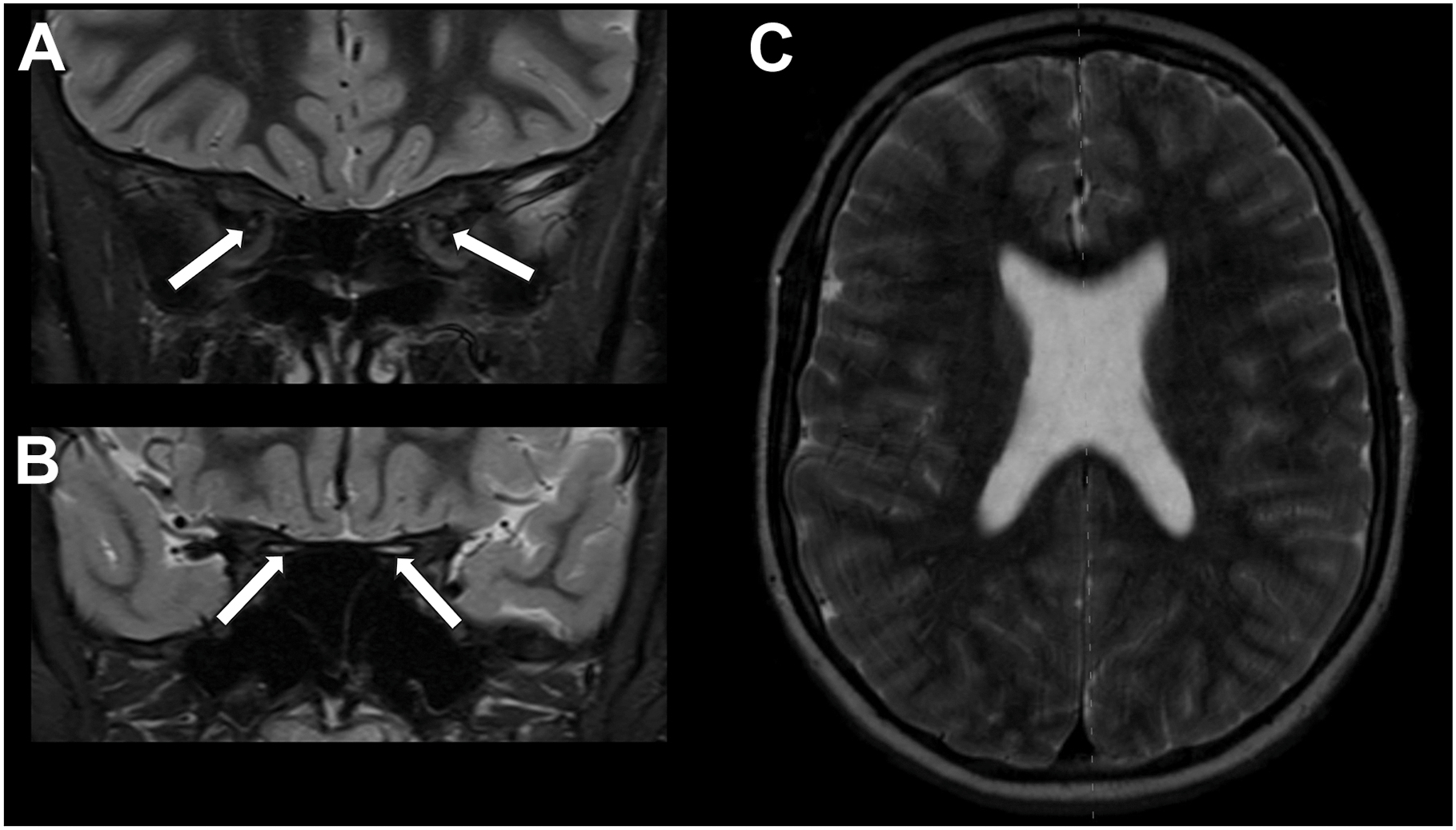 A three-panel magnetic resonance imaging scan shows septo-optic dysplasia with diminutive bilateral optic nerves and an absent septum pellucidum.