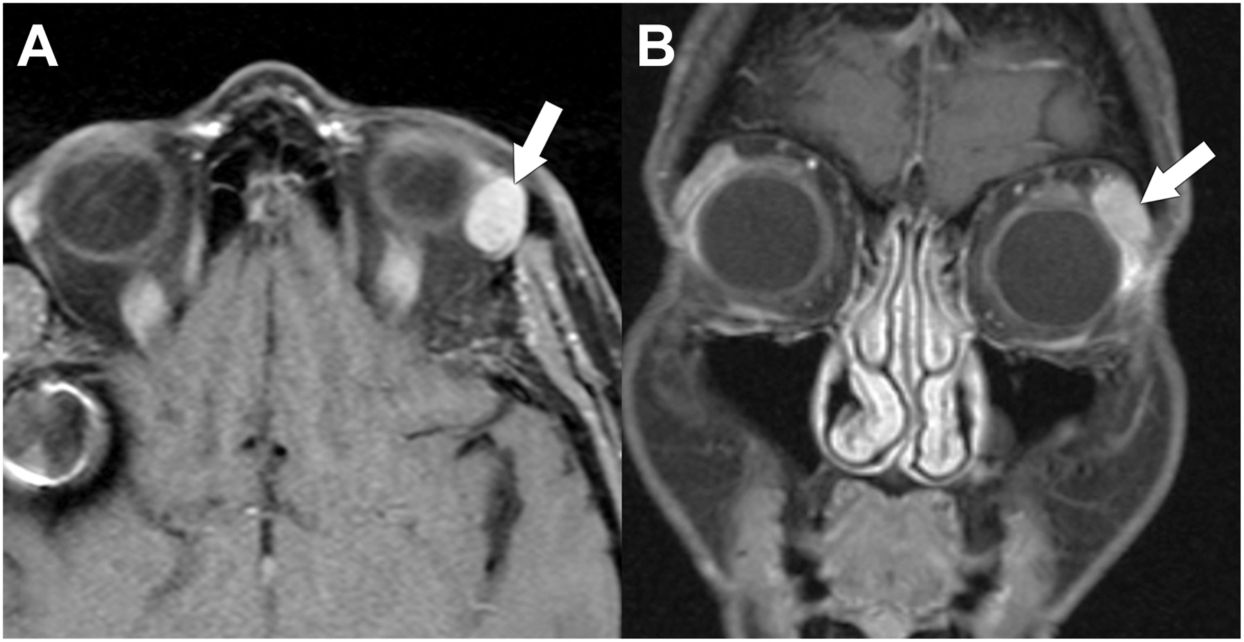 A set of two magnetic resonance imaging scans demonstrates a left lacrimal gland pleomorphic adenoma, marked by arrows pointing to a well-circumscribed, enhancing mass.