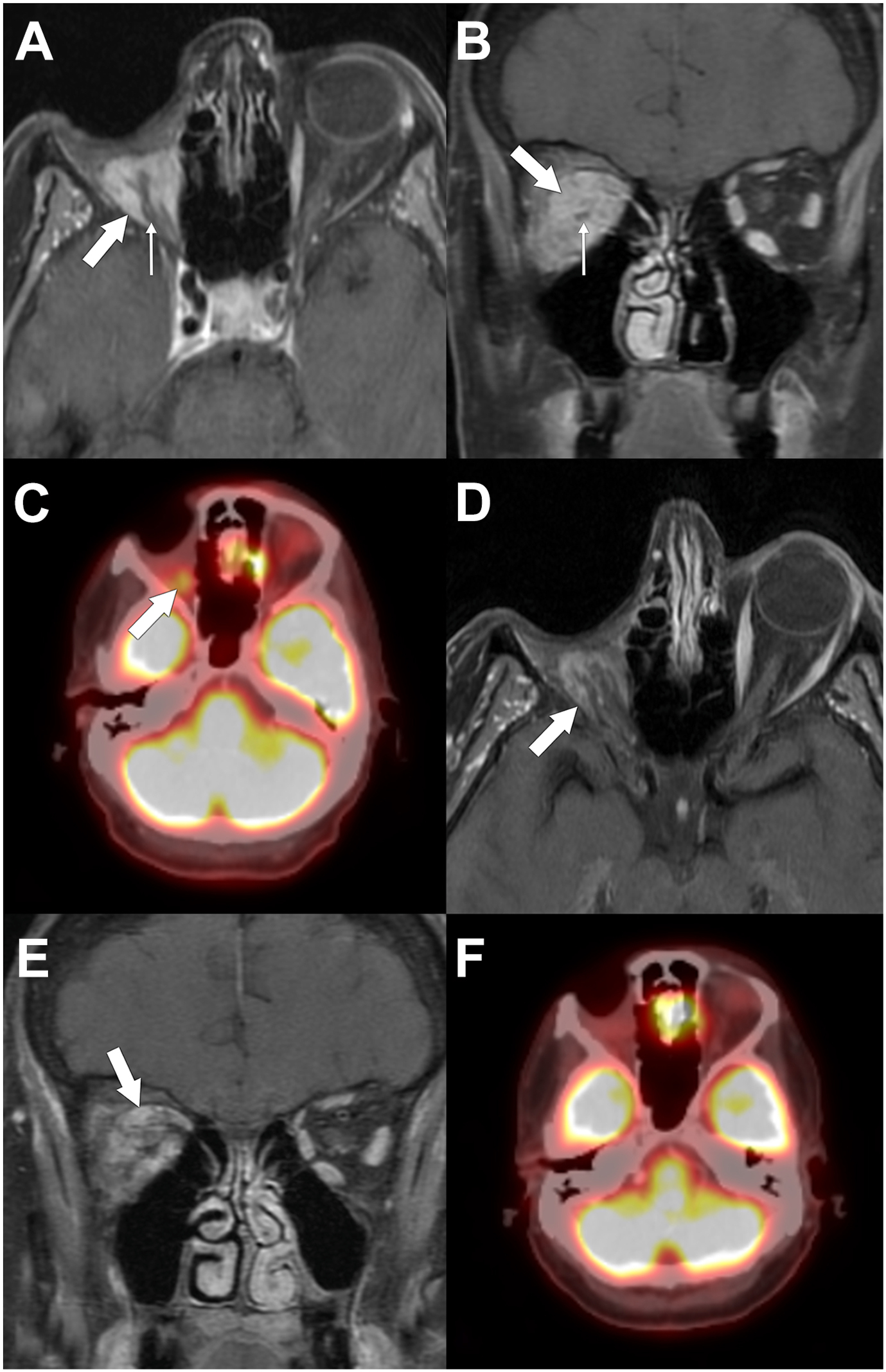 A set of six panels shows post-operative changes after right orbital exenteration with myocutaneous flap reconstruction using magnetic resonance imaging and positron emission tomography scans.