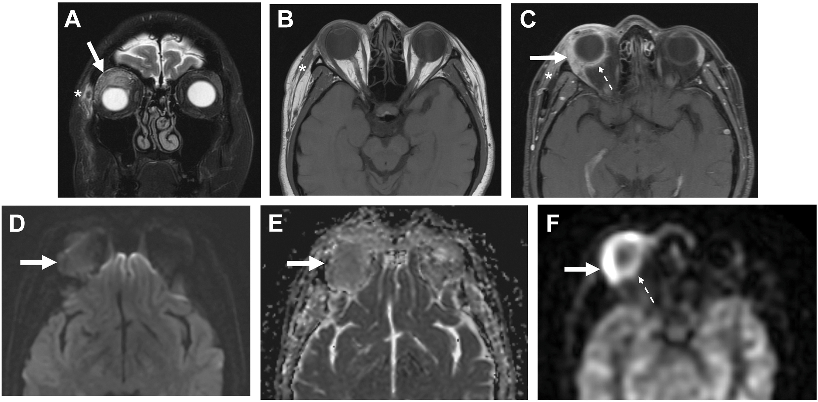 A six-part magnetic resonance imaging scan of a 50-year-old female patient shows idiopathic orbital inflammation with a right superolateral orbit mass and adjacent tissue edema.