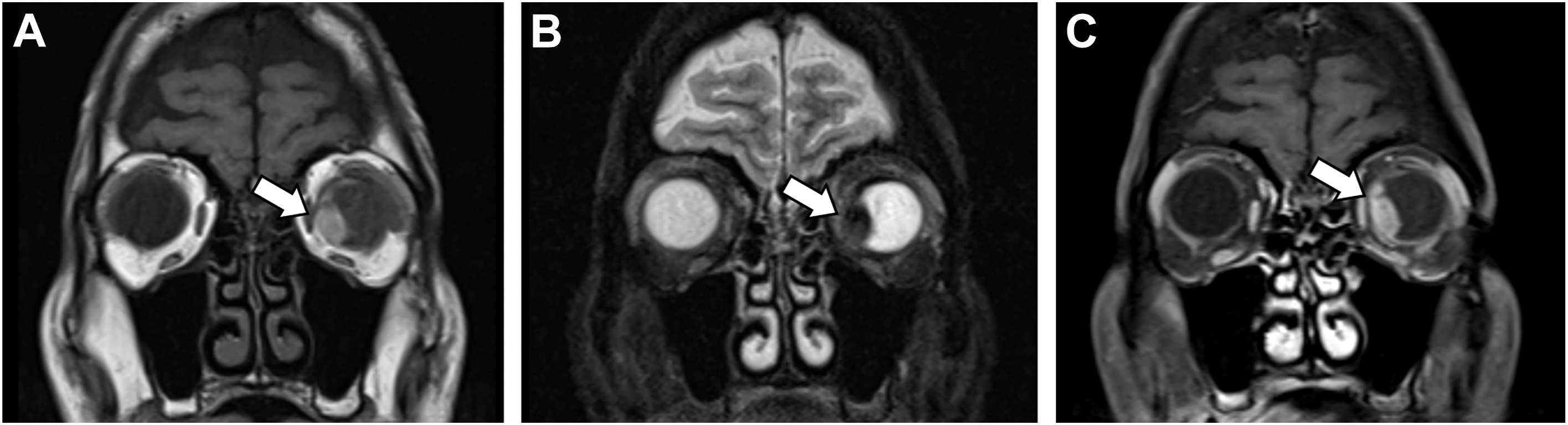 Three coronal M R I scans illustrate a uveal melanoma affecting the medial aspect of the left eyeball.