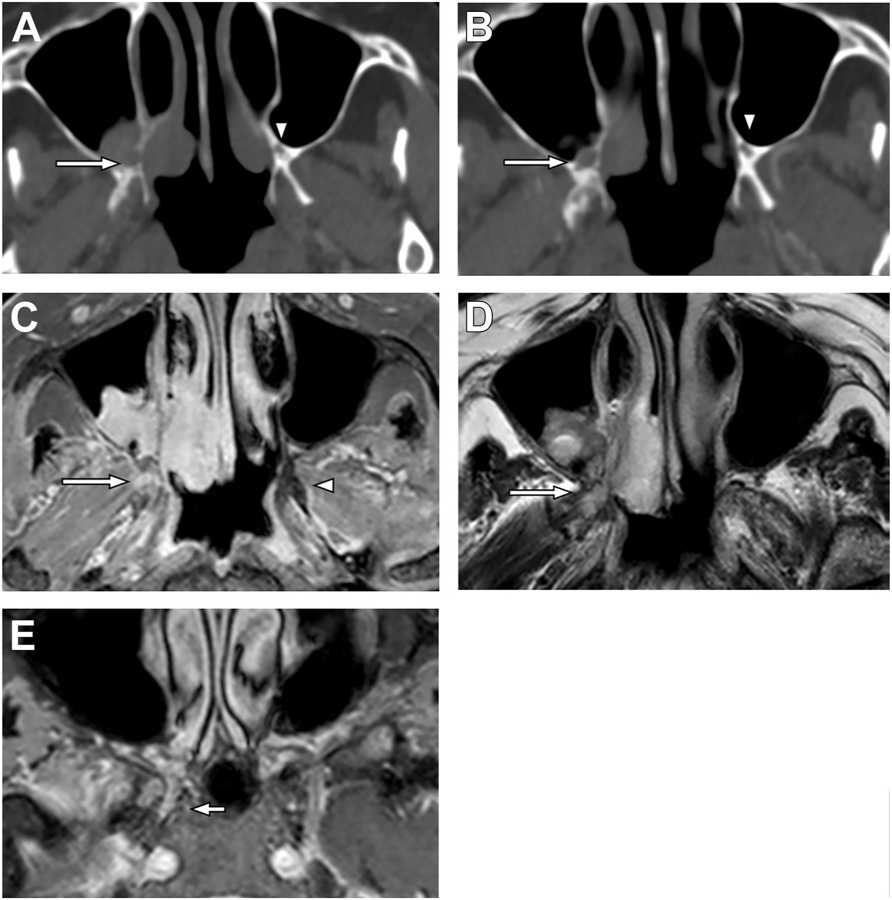 A set of five C T and M R I scan sections presents axial views of the sinuses and orbits, each with arrows and stars marking abnormal areas and specific anatomical regions.