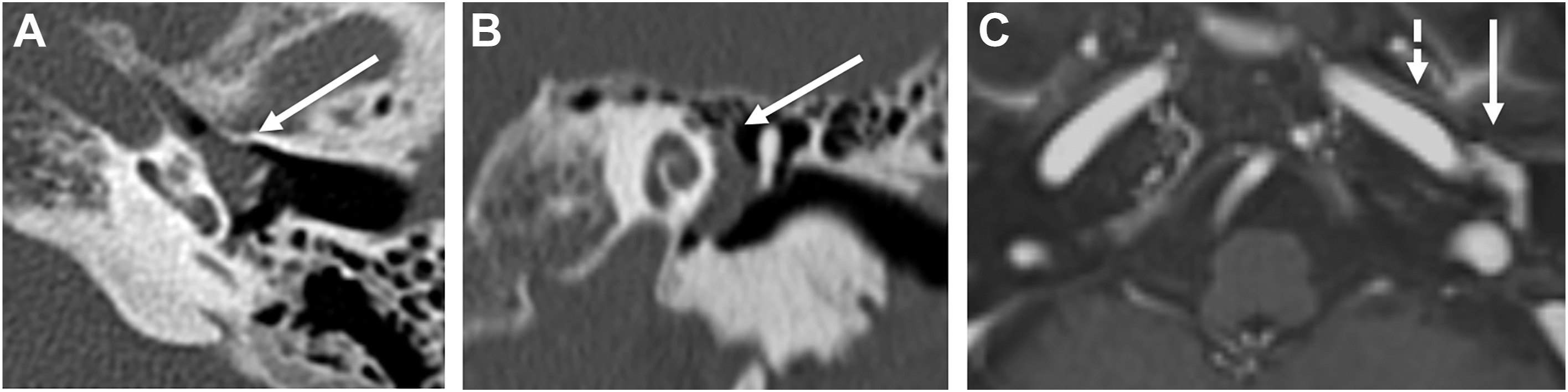 A two C T and an M R I scan shows abnormal enhancement posterior to the petrous internal carotid artery.