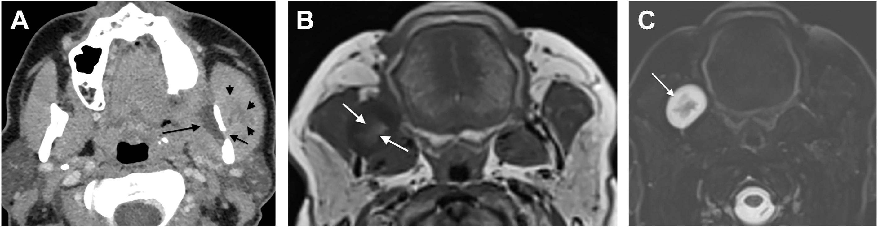 Three computed tomography scans show a cystic lesion with central low intensity content in the mandible with preserved surrounding bone structure.