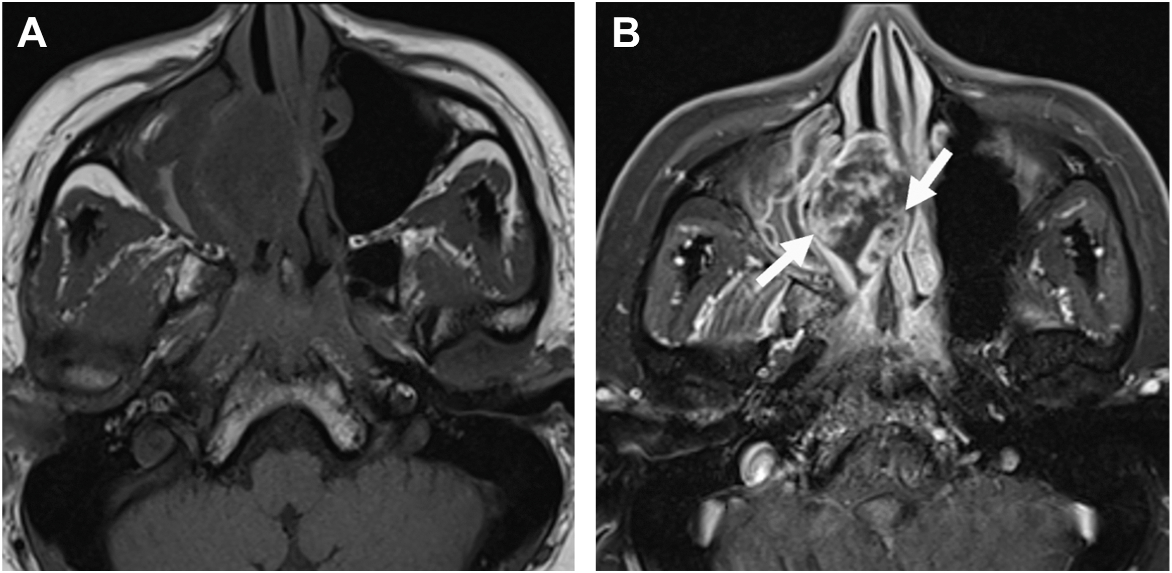 An axial M R I pair with a heterogeneous nasal mass seen more clearly on the right scan, where two arrows mark its irregular contours and invasion into nearby nasal structures.