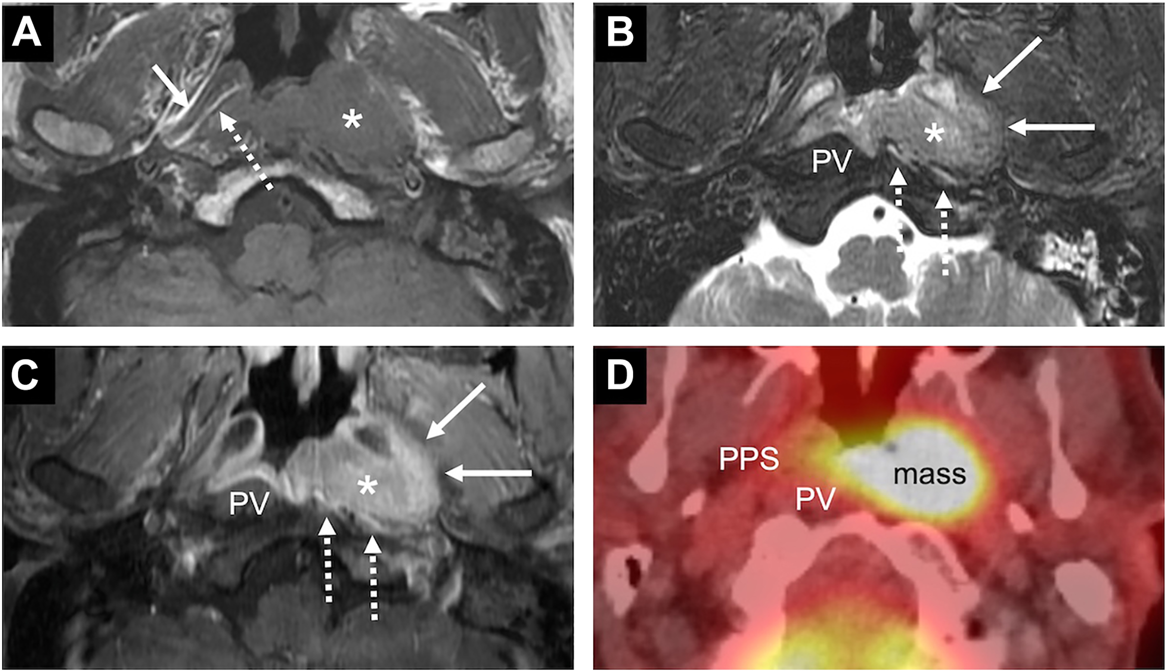 An axial series of M R I and P E T scans highlighting a parapharyngeal mass with arrows and asterisks pointing to anatomical structures, including P V and P P S regions, across four labeled sections.