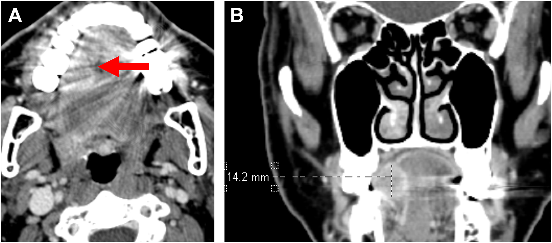 An axial and coronal post-contrast C T scan depicts right lateral tongue S C C measuring about 1.4 centimeters, with a pathologic depth of invasion of 1.6 centimeters.