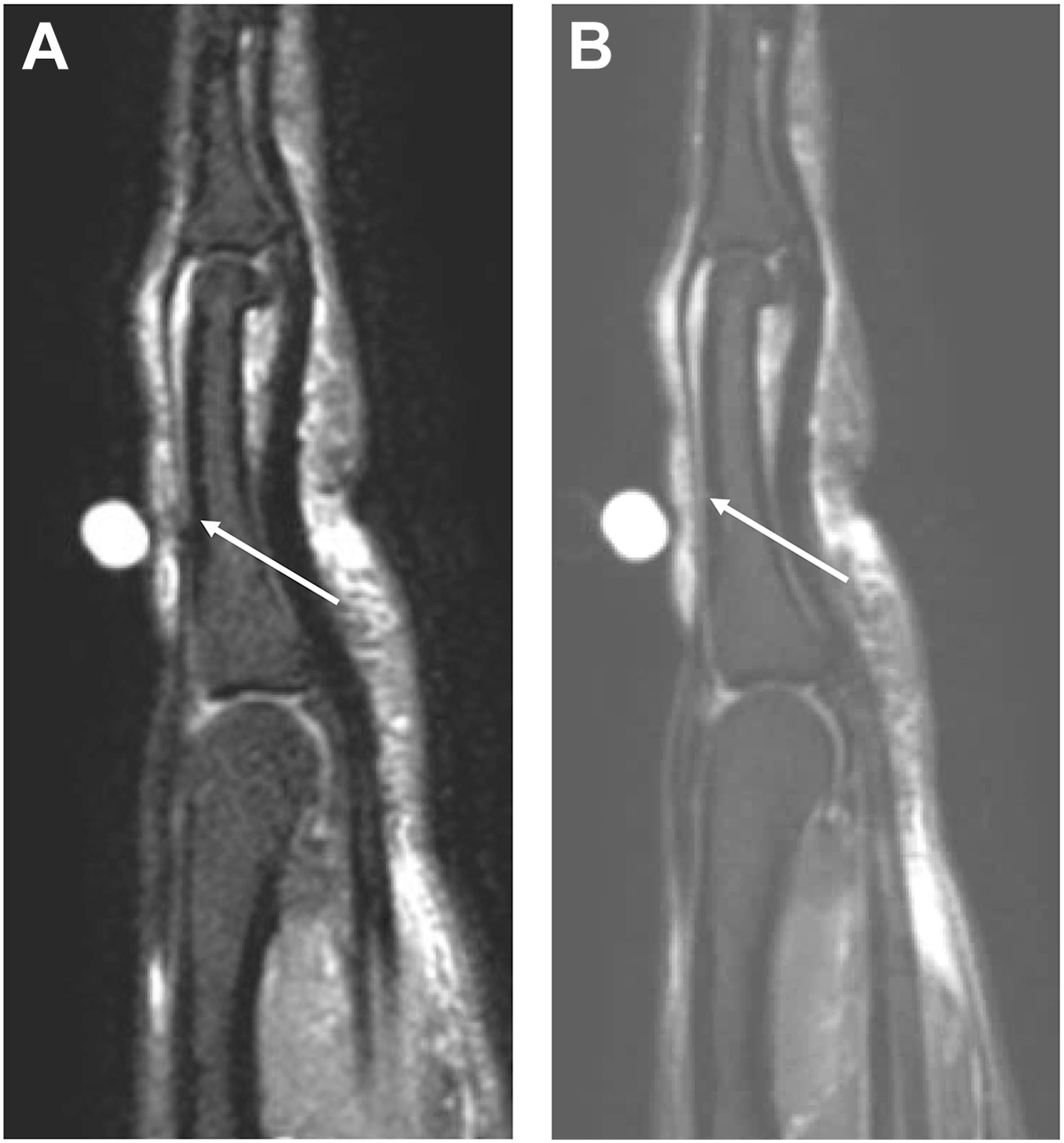 A set of two sagittal M R I scans, A and B, compares a 3 d and 2 d reconstruction of a finger. Panel A shows a partial extensor tendon tear, which is not shown in panel B.