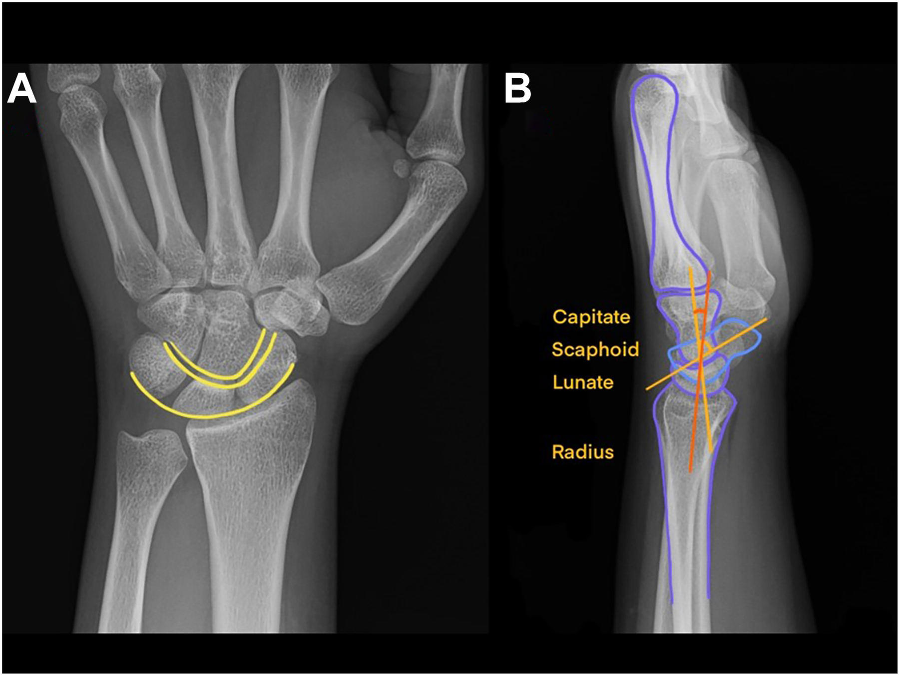 Two X-rays of a wrist show a P A view with parallel curved lines and angled lines to demonstrate the scapholunate and lunocapitate angles.