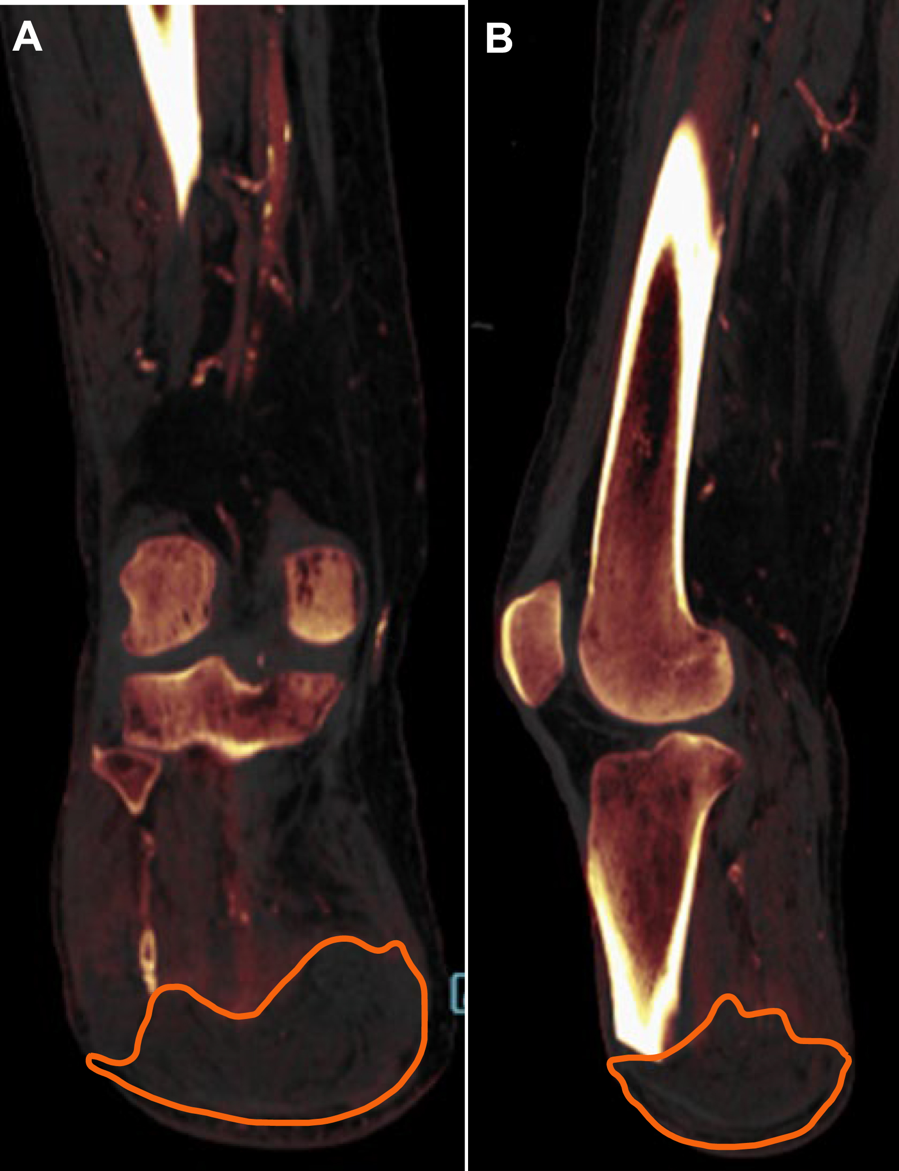 Role of DECT in evaluation of infection following limb amputation.