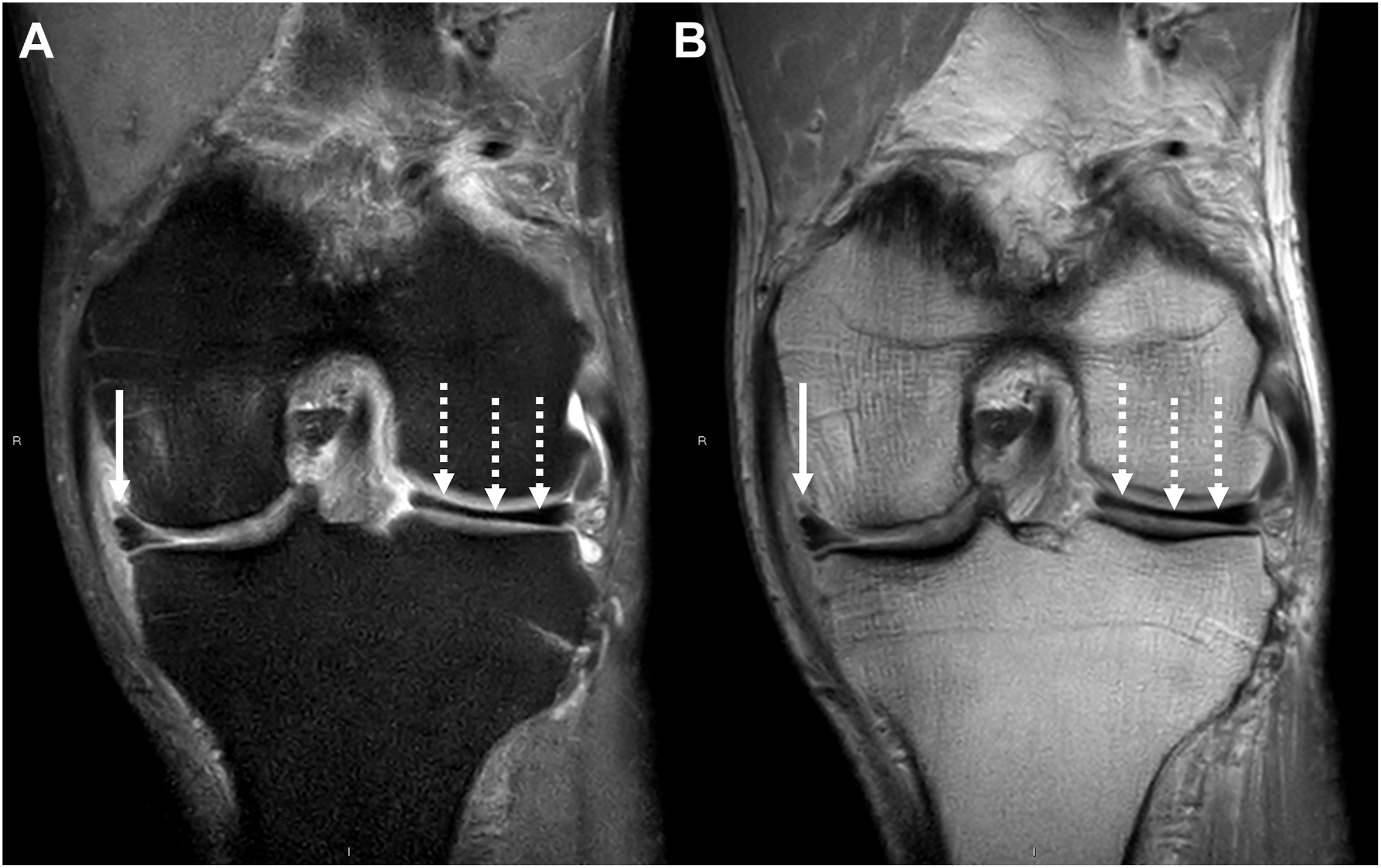 A two-panel M R I of a left knee shows a complex flap tear of the medial meniscus, marked by a solid arrow, and a complete discoid lateral meniscus, marked by dashed arrows.