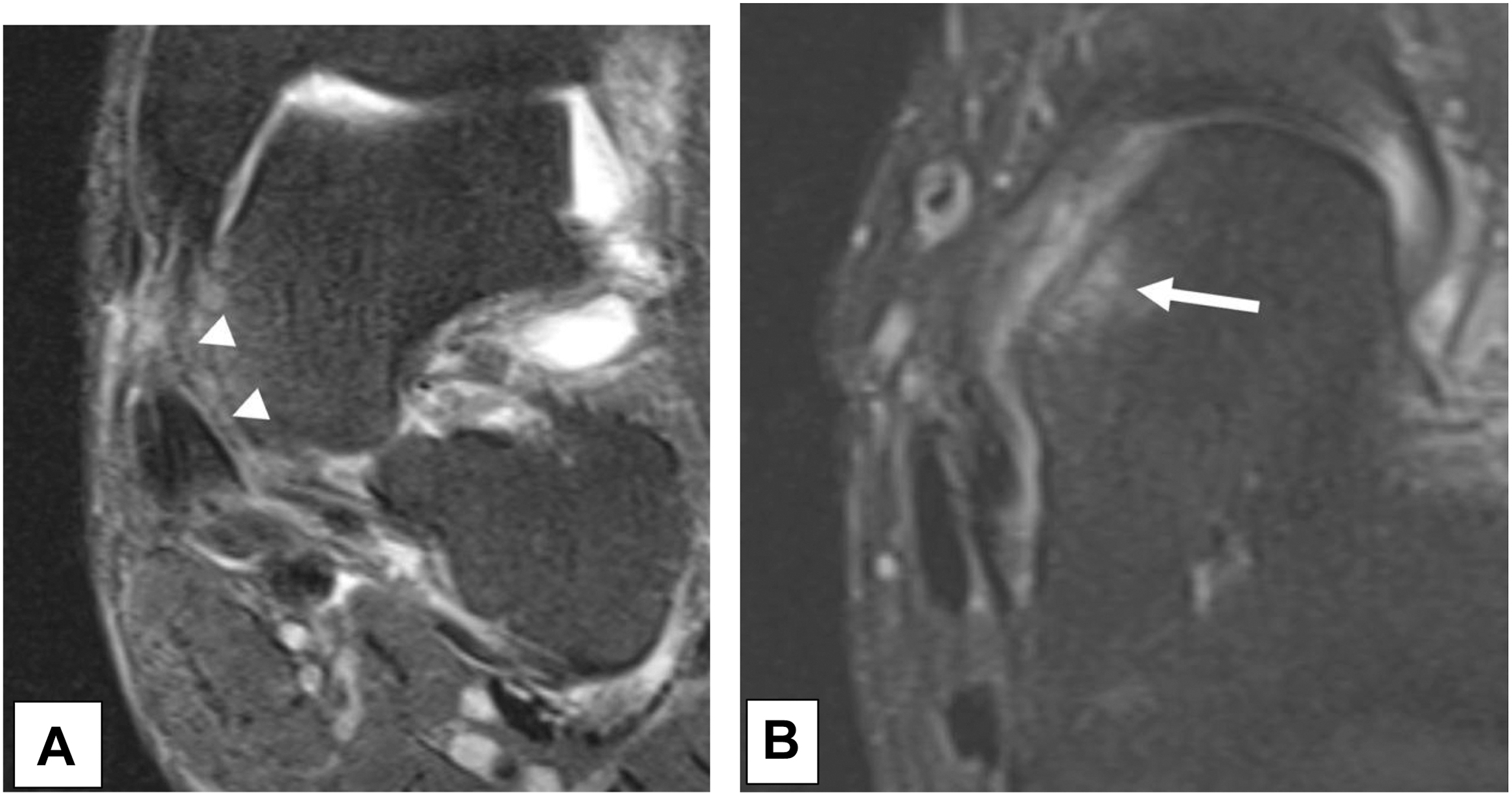 A set of two M R I scans, And B, shows a spring ligament tear. The coronal scan (A) shows the attenuated ligament (arrowheads), and the axial scan (B) shows a talar head bone contusion (arrow).
