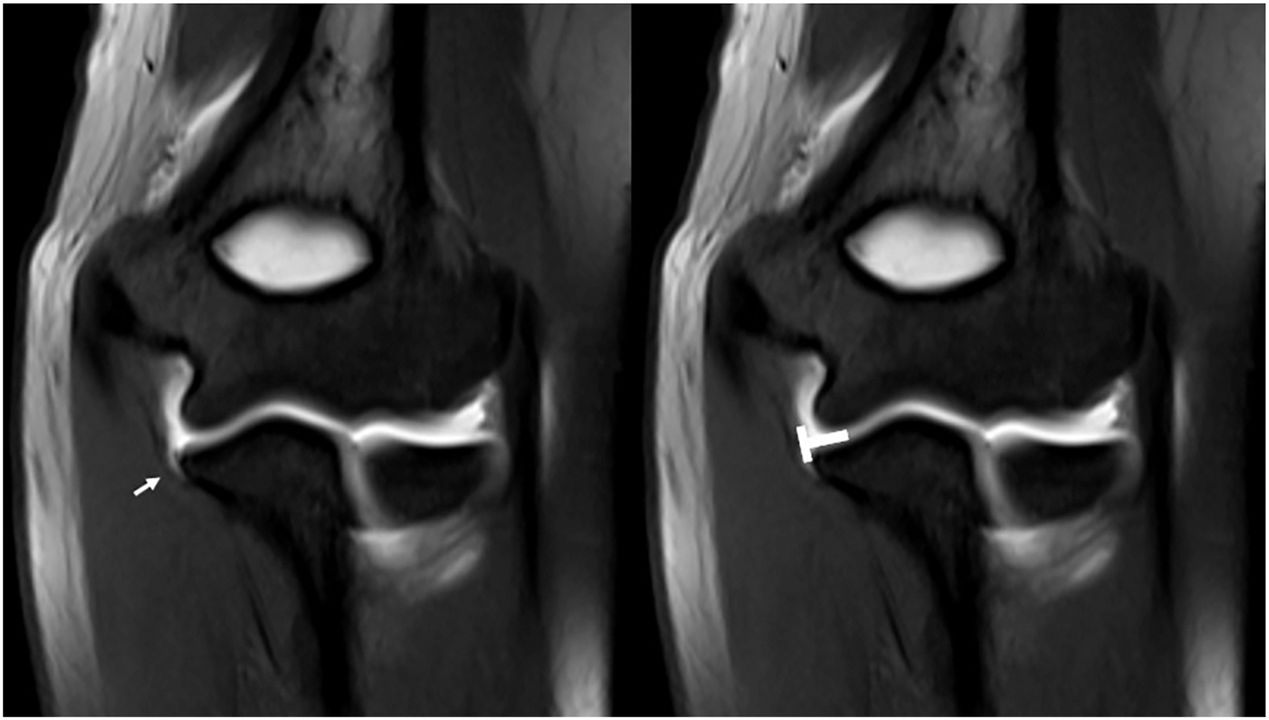 Two M R I scans show an arrow pointing to a tear in a ligament and the contrast dye forming a T-shape.