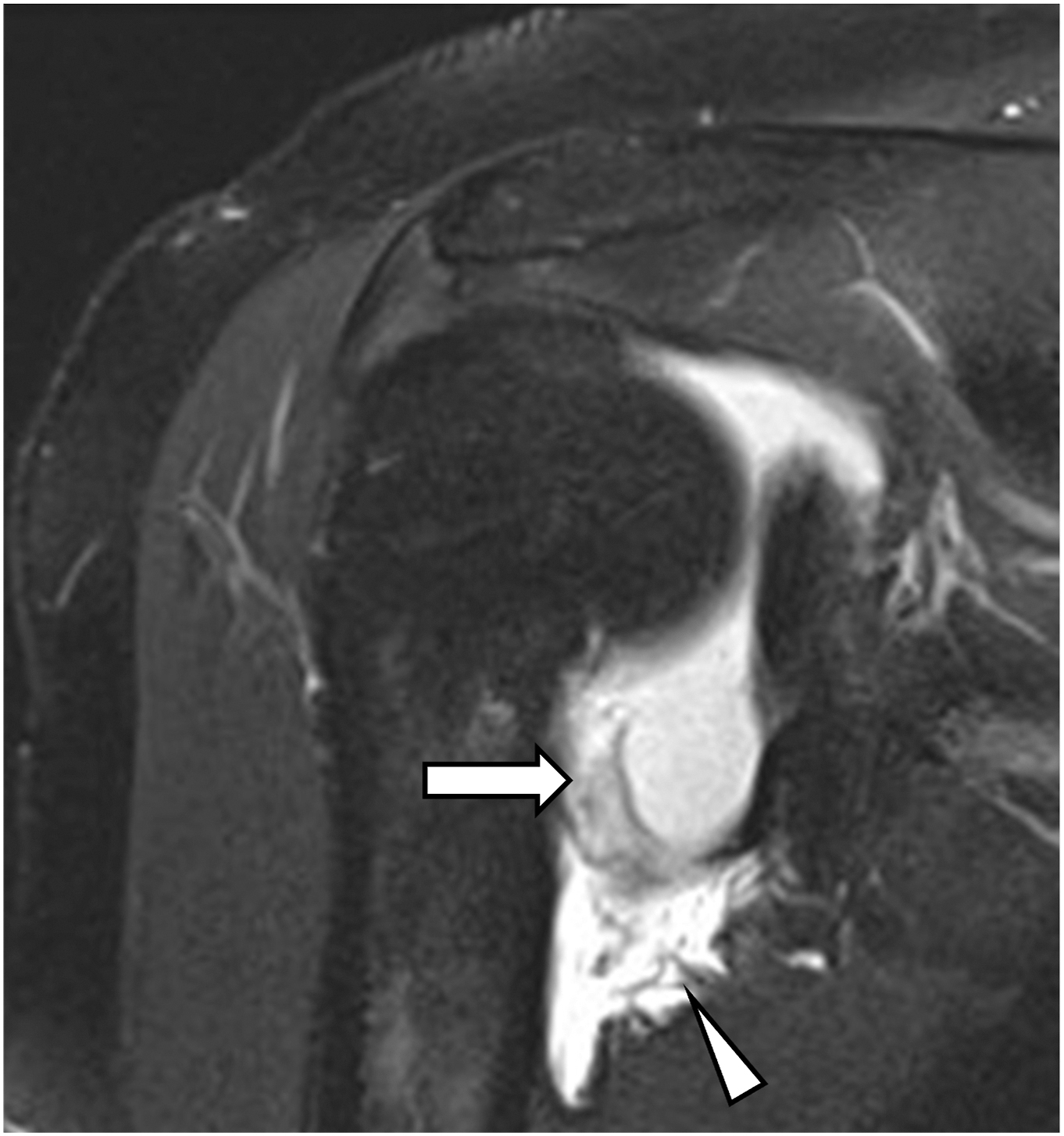 A coronal shoulder scan shows a torn ligament pulled from its attachment with joint fluid buildup and contrast spread in the recess.