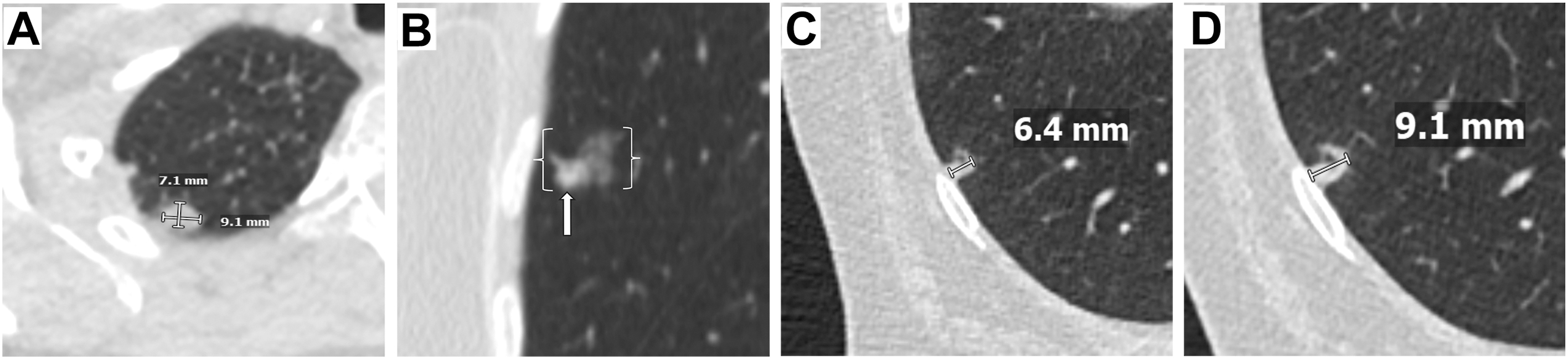 Four axial unenhanced chest C T scans show Lung-R A D S category 4 nodules, including a 9 millimeter solid nodule, a 12 millimeter part-solid nodule, and a nodule increasing from 6 to 9 millimeters.