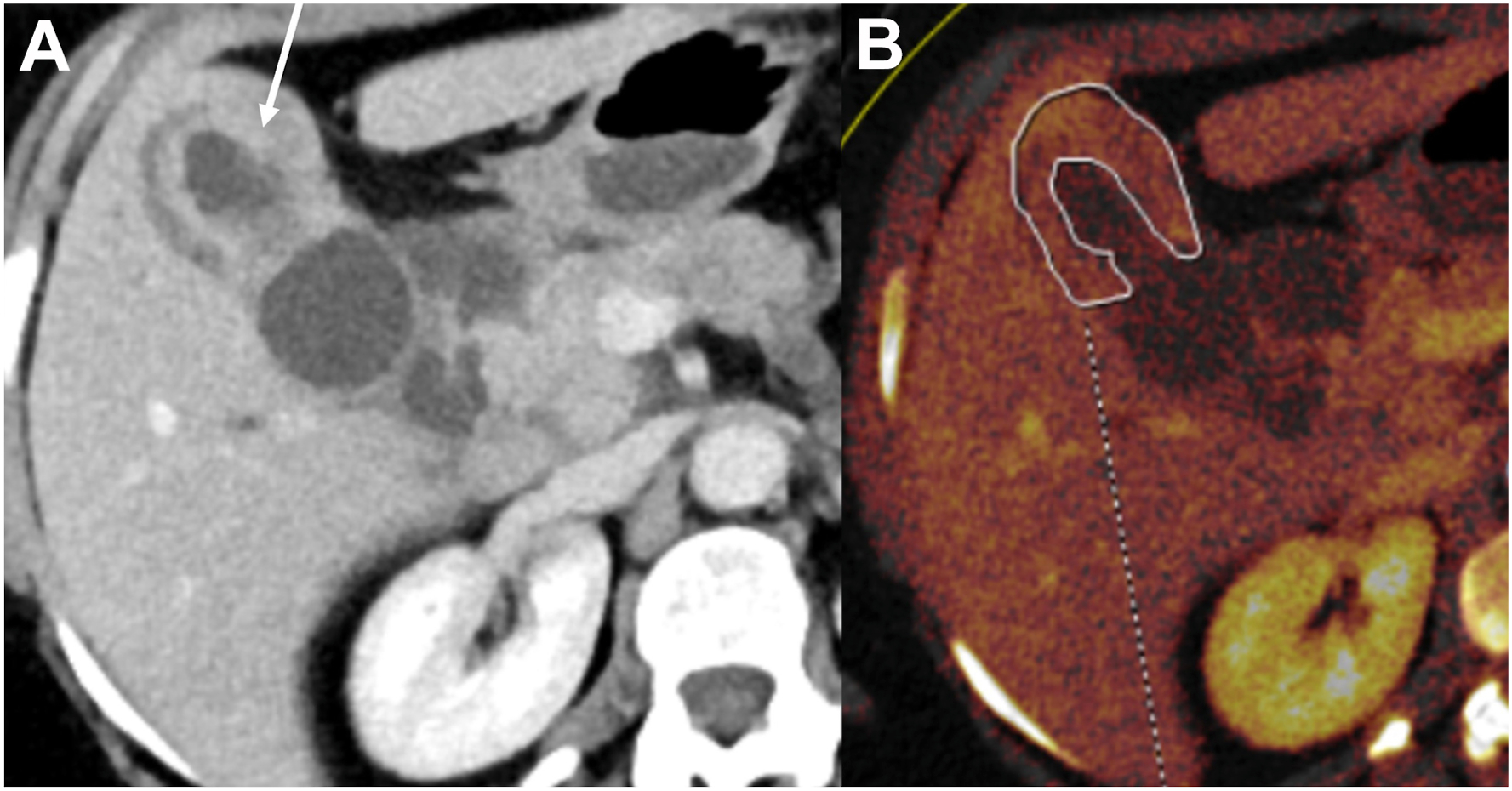 Two dual-energy computed tomography scans show diffuse asymmetric gallbladder wall thickening with heterogeneous enhancement, layered inner wall enhancement, and heterogeneous iodine uptake.