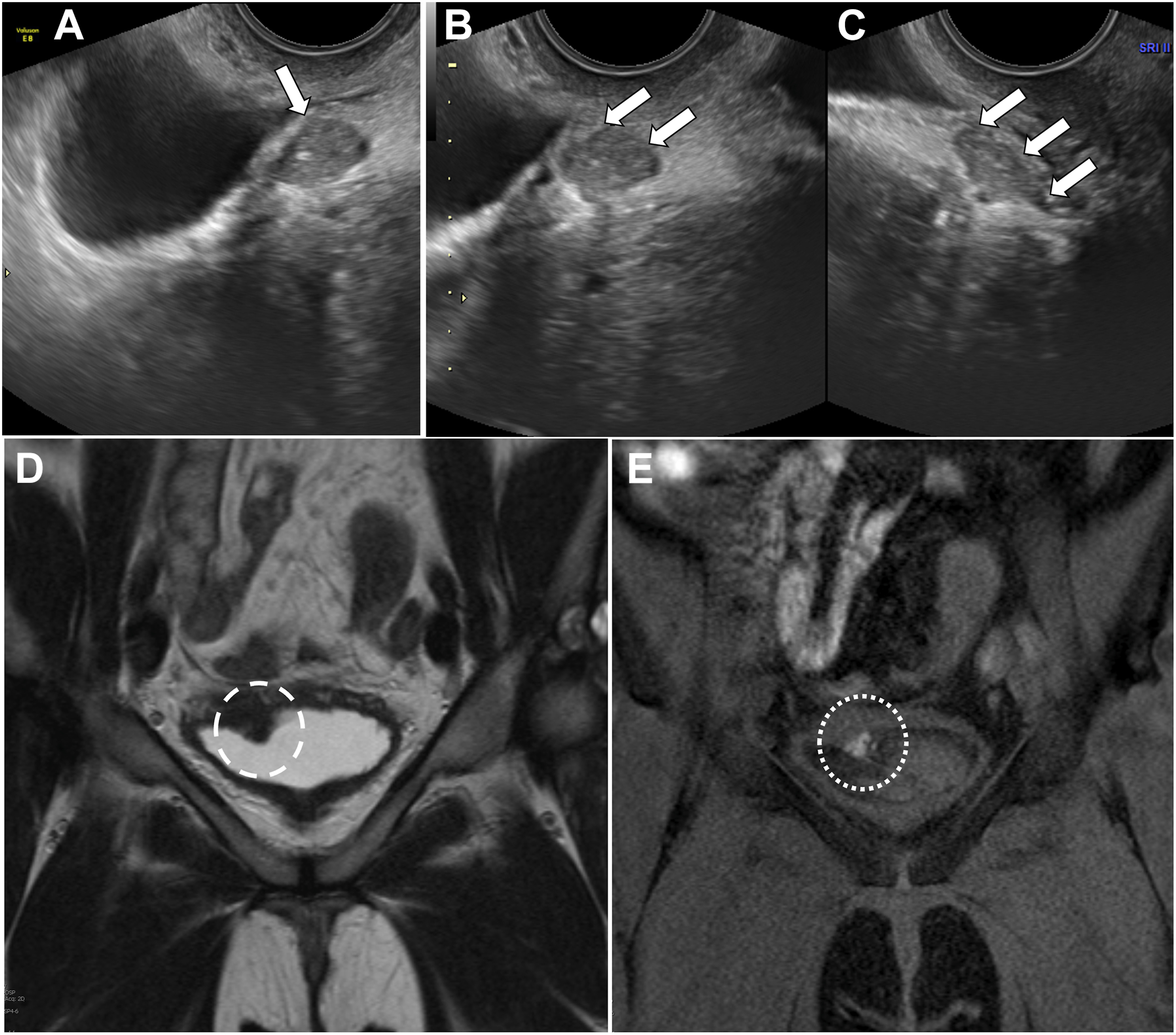 Five panels show bladder deep endometriosis with a hypoechoic nodule along the posterior bladder wall on transvaginal ultrasound and a T 2-dark lesion with T 1 foci at the bladder dome on M R I.