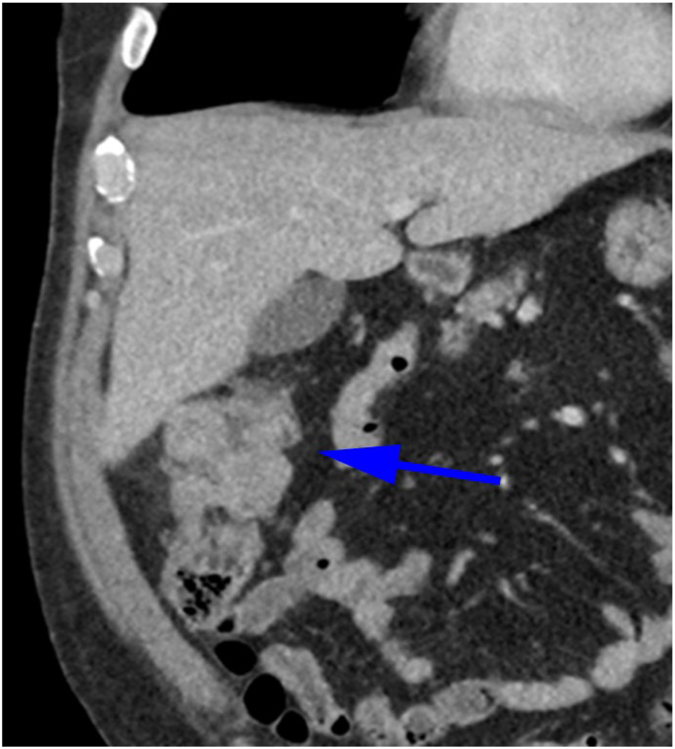 A coronal contrast-enhanced C T shows a lobulated enhancing mass at the hepatic flexure, representing colonic adenocarcinoma in a 56-year-old man with Lynch syndrome.