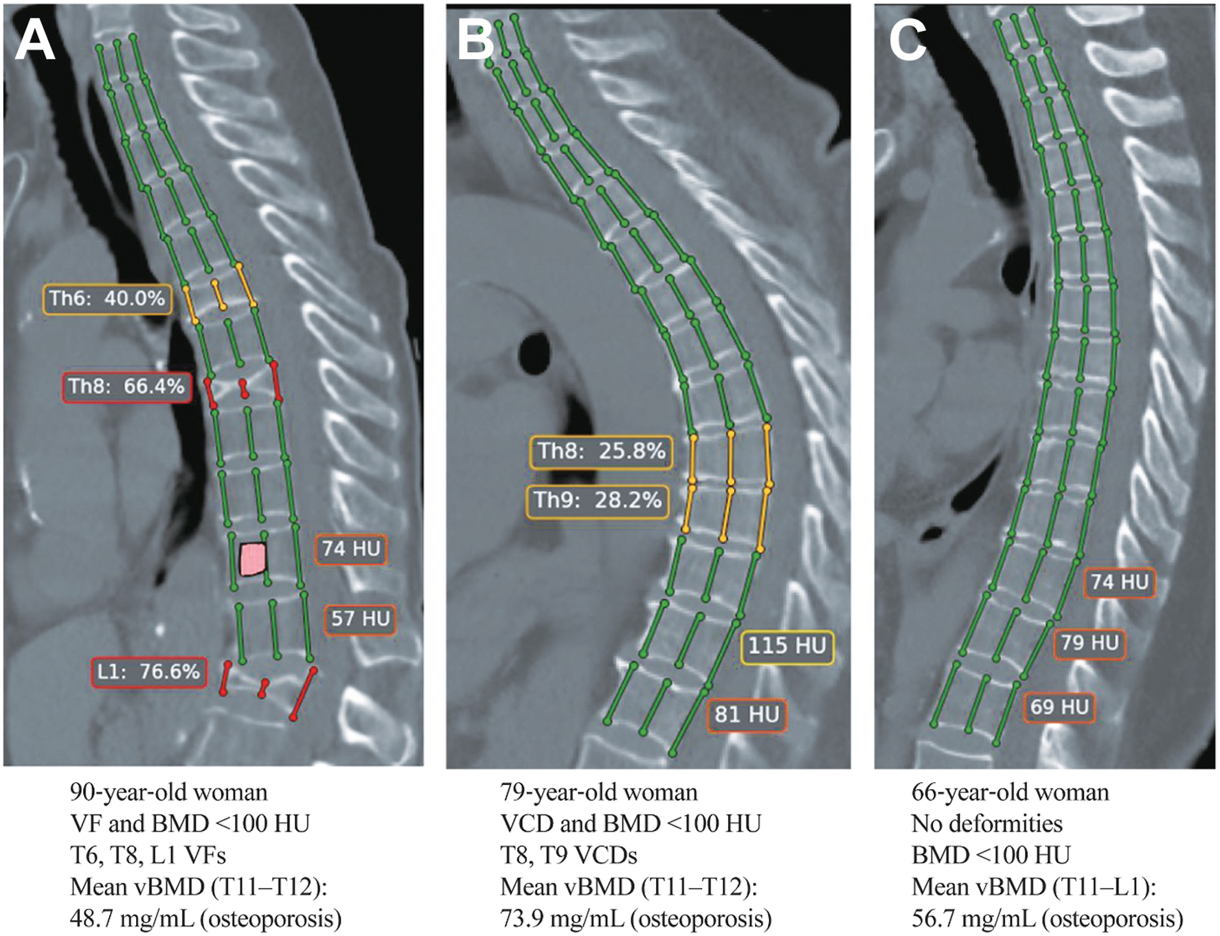 Three sagittal C T of the thoracic spine in three women with osteoporosis show automated detection of vertebral fractures and bone mineral density levels.