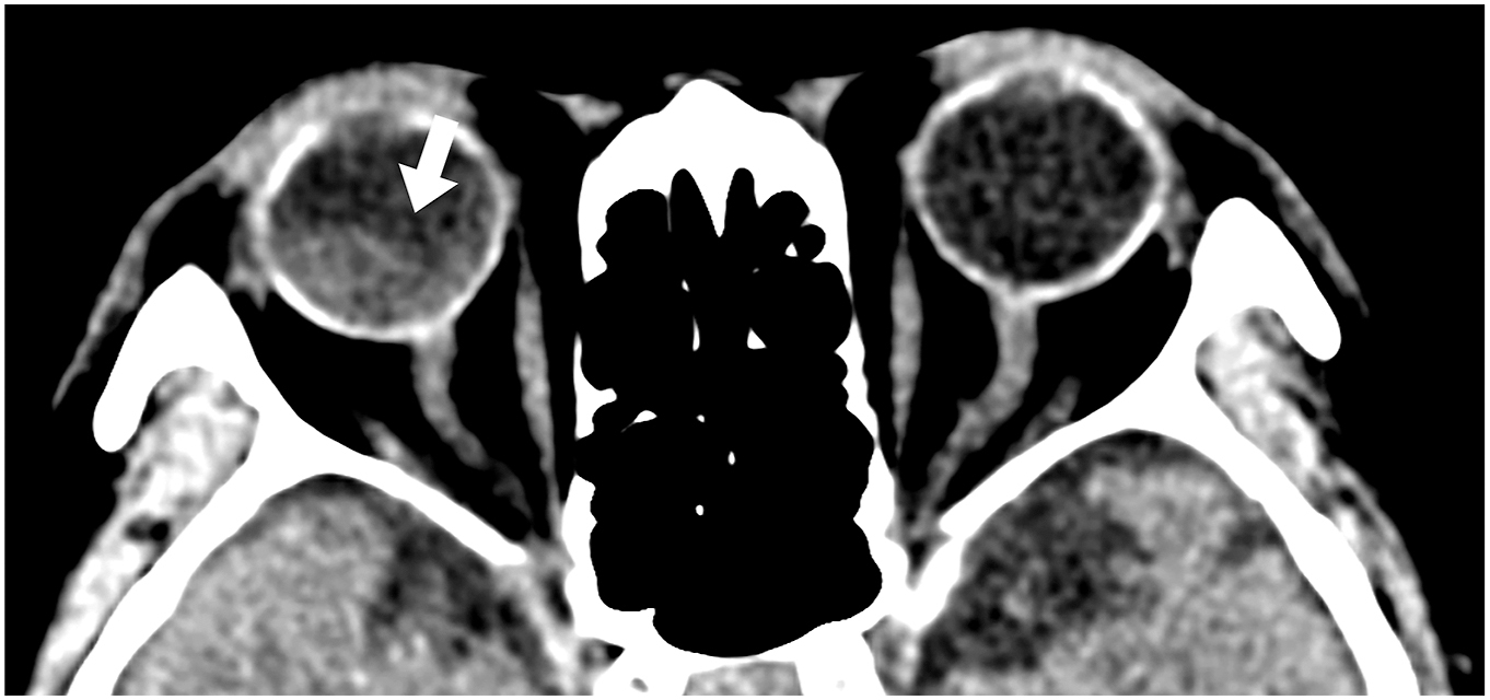 A C T scan of the brain shows hyperdense fluid at the posterior right globe crossing the optic disc without attachment, consistent with posterior hyaloid detachment.