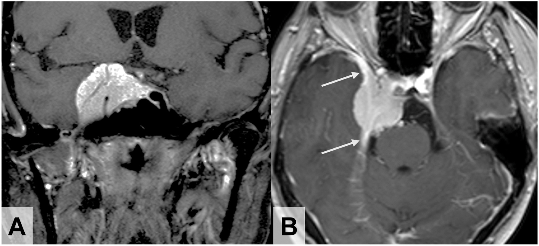A coronal and axial contrast-enhanced T 1 W M R I shows a cavernous sinus meningioma filling the C S, with dural tails and narrowing of the cavernous internal carotid artery.
