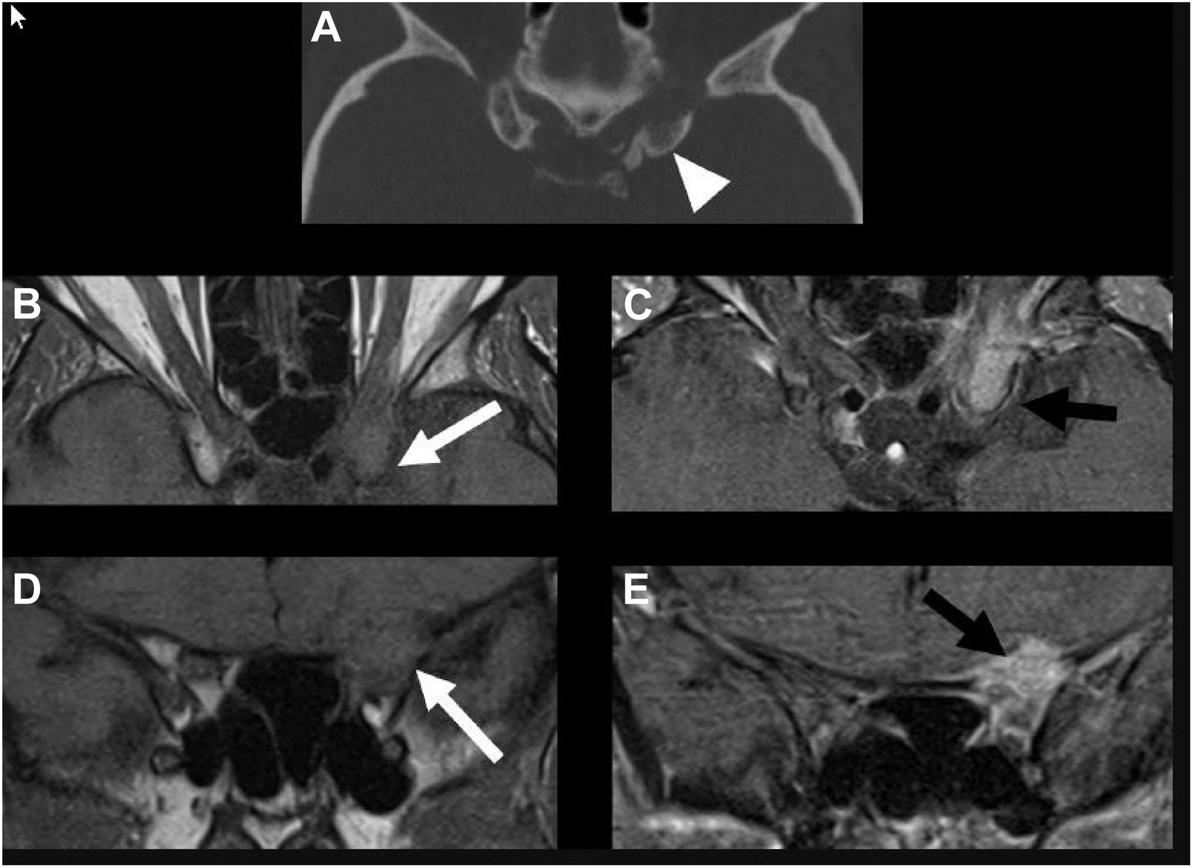 A five-panel C T and M R I of urothelial carcinoma metastases shows a lytic lesion in the anterior clinoid process with a loss of marrow signal, avid enhancement, and extension into the optic canal.