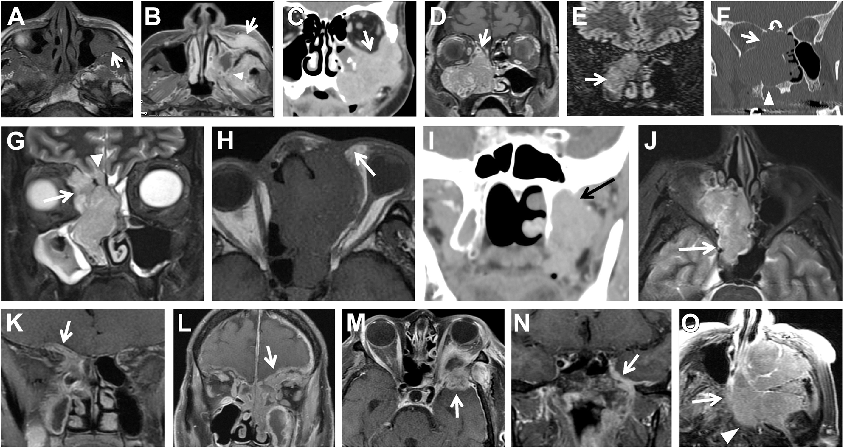 A composite panel of radiologic scans shows anatomical landmarks used for T staging of sinonasal malignancies.