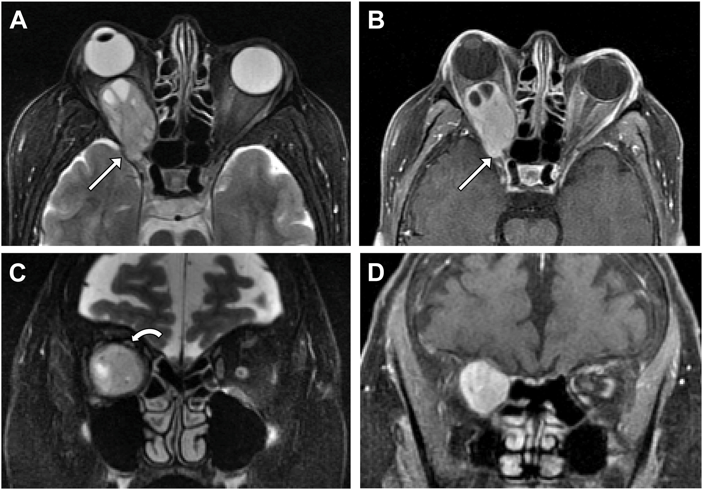 A four-panel fat-saturated magnetic resonance images show a large right orbital schwannoma with cystic changes, avid enhancement, significant proptosis, and optic nerve displacement.