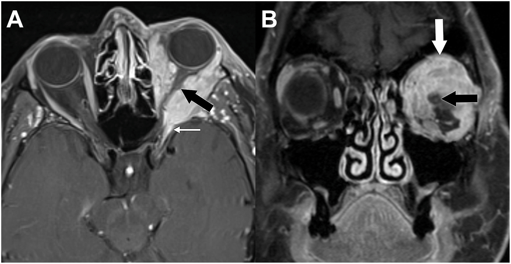 A set of two magnetic resonance imaging scans shows an infiltrating left lacrimal gland adenoid cystic carcinoma that encases the optic nerve and involves the extraocular muscles and orbital roof.