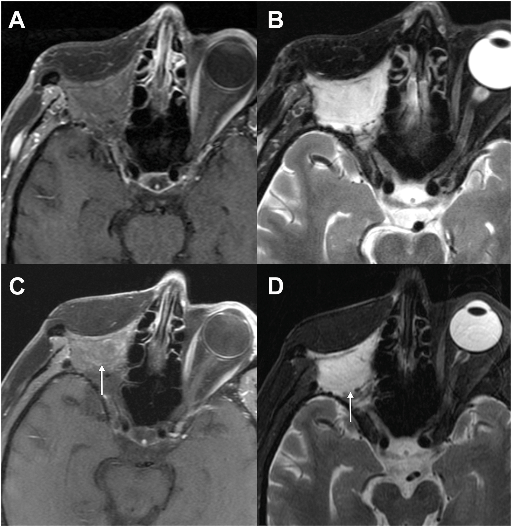 A set of four magnetic resonance imaging scans demonstrates radiation effects on a myocutaneous flap in the right orbit, with arrows pointing to the enhanced muscular component after treatment.