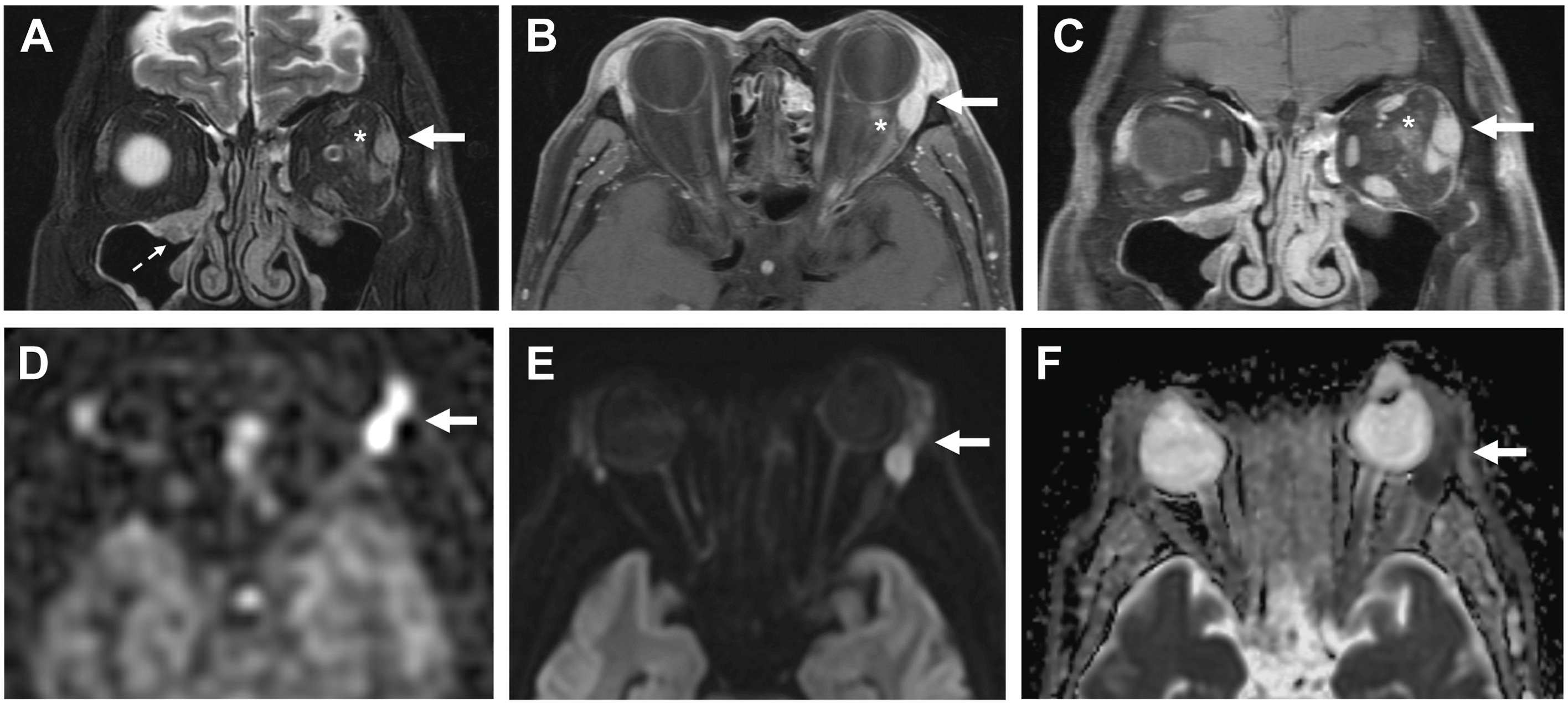 A six-panel magnetic resonance imaging scan of a 60-year-old female with immunoglobulin G 4-related disease shows an enlarged left lacrimal gland with low diffusivity and elevated perfusion.