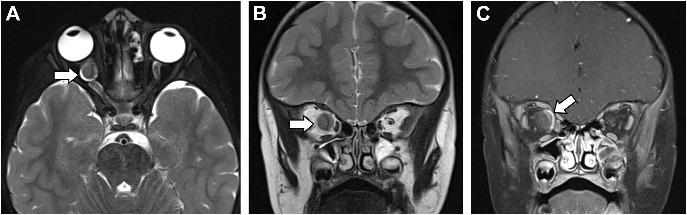 Three M R I scans of a young child's brain and eyes, showing a tumor on the optic nerve.