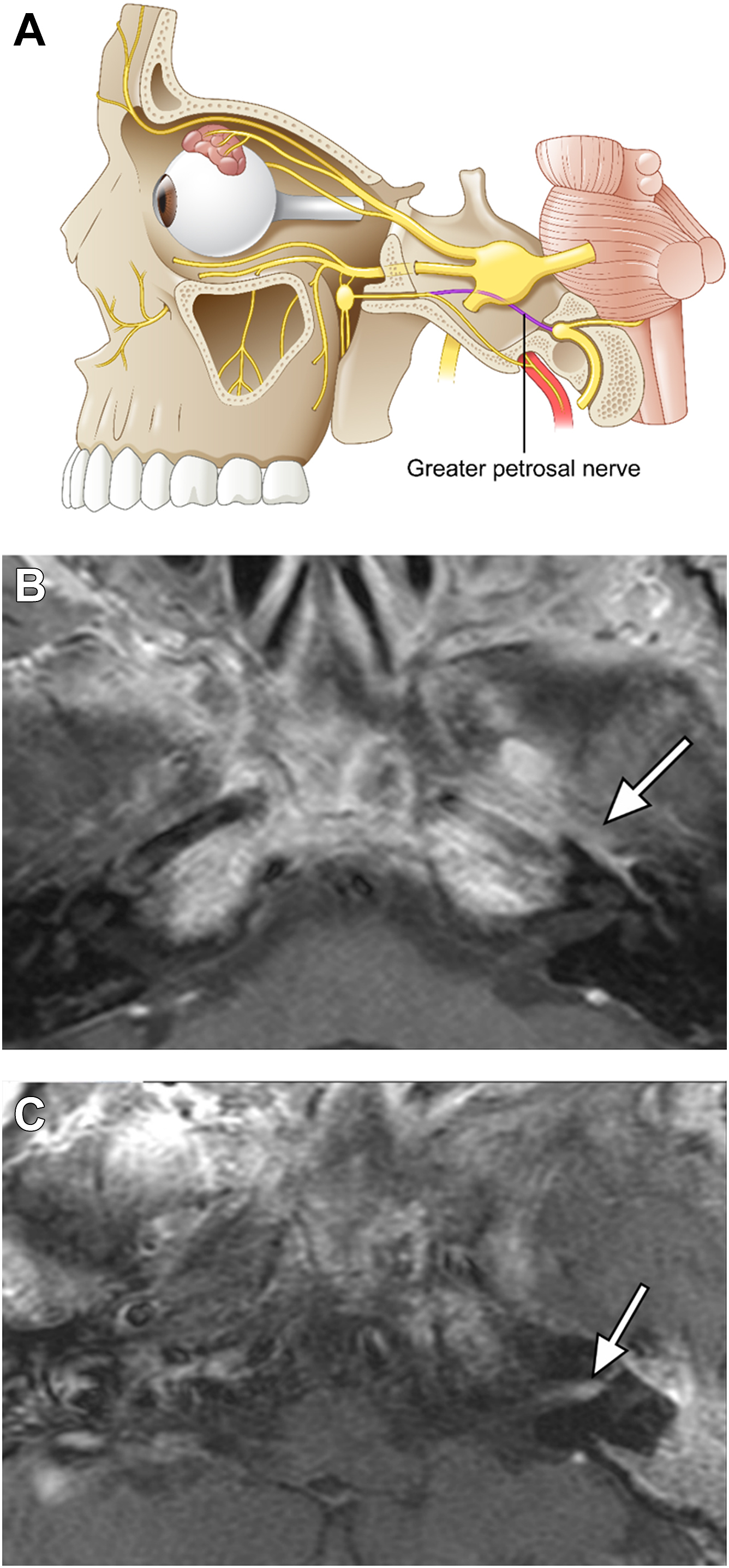 An anatomical diagram and two M R I scans show the course of the maxillary nerve and enhancement in the pterygopalatine fossa, with arrows marking inflammation or neural involvement.