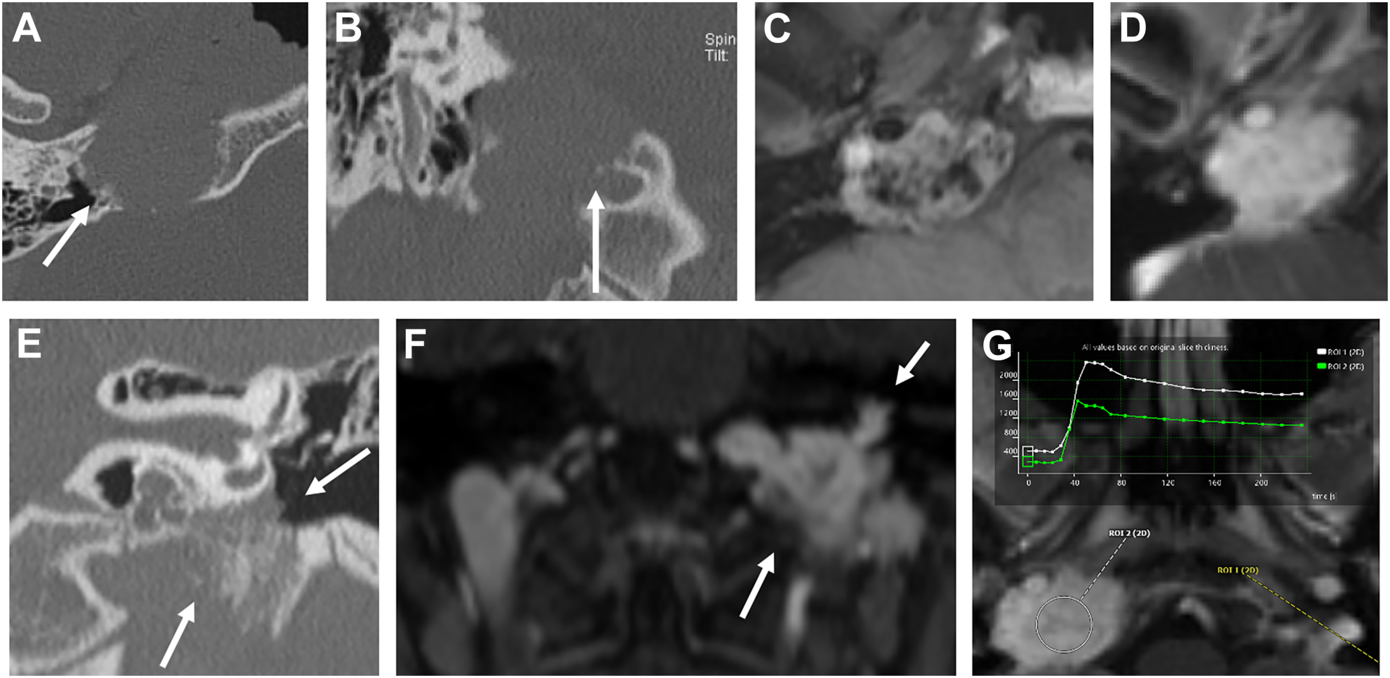 Seven panels with axial, coronal, and contrast series of scans showing a vascular mass at the skull base with bone erosion and middle ear extension.