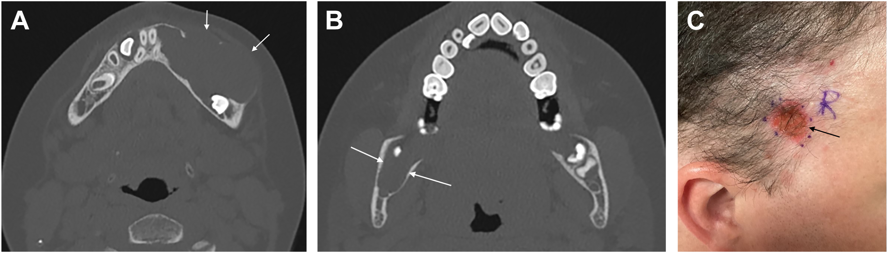 Three images show computed tomography scans of jaw cysts and a photograph of a scalp lesion in a patient with basal cell nevus syndrome.